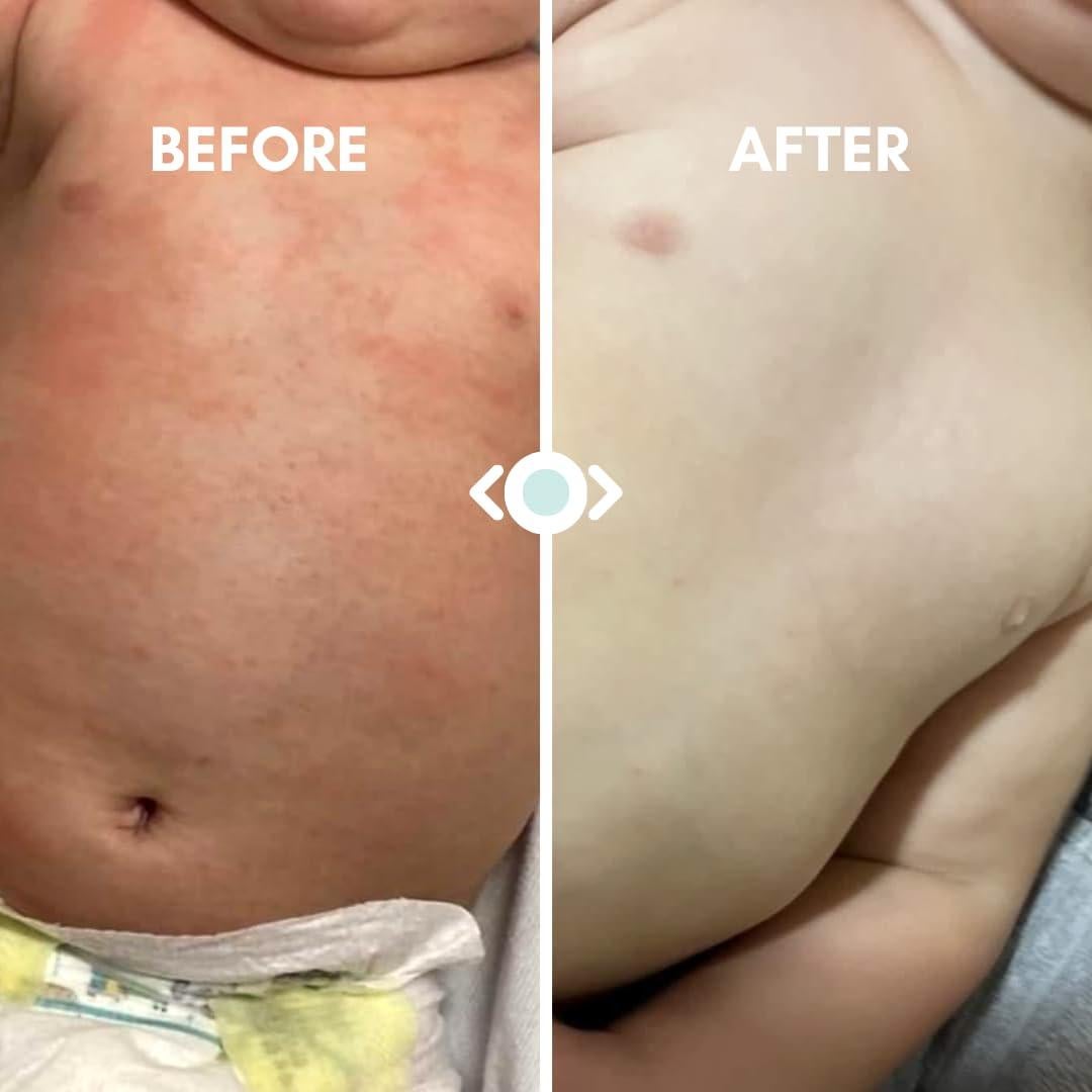 Bálsamo para Eczema Bebé - Crema Hidratante 226g