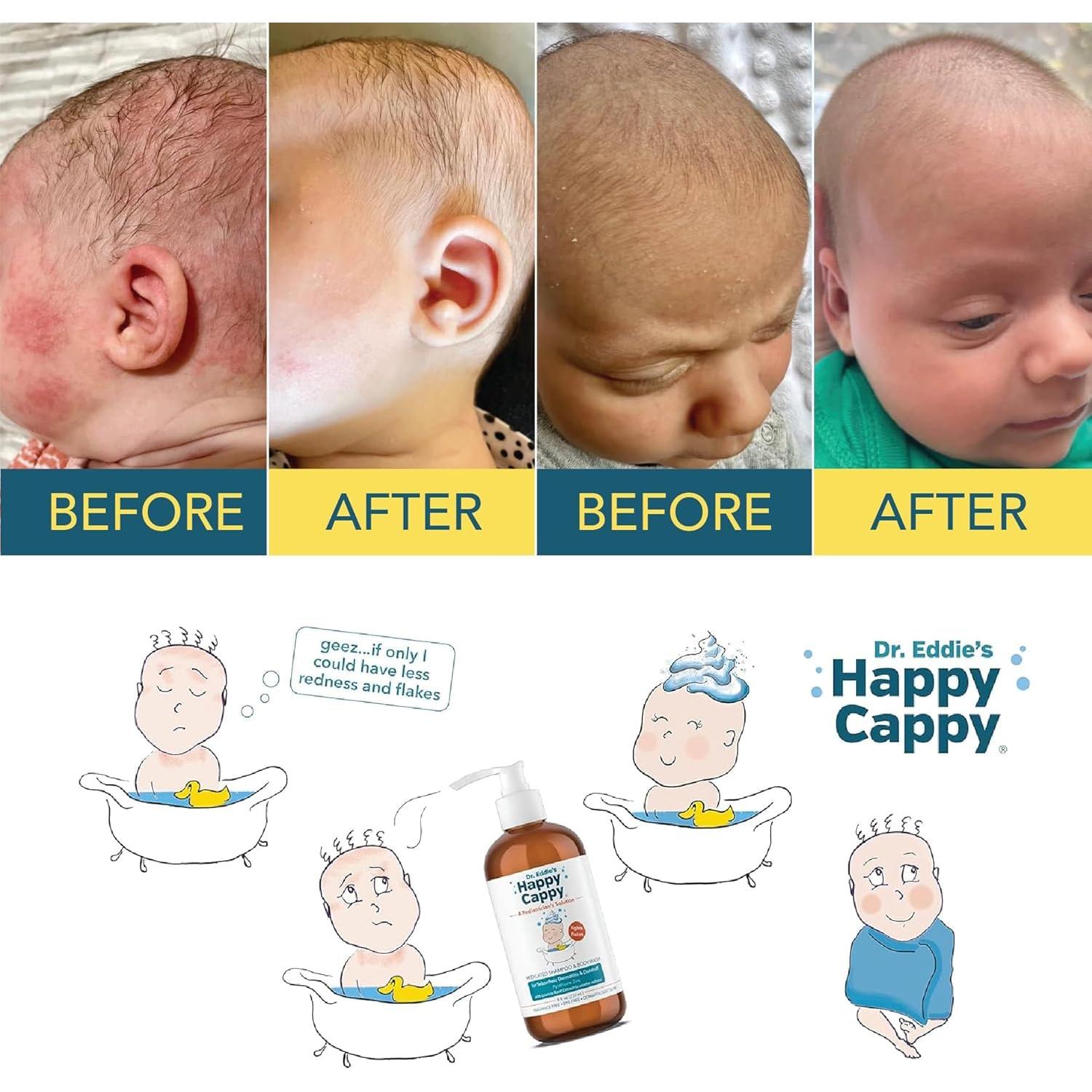 Champú y gel de baño medicado Happy Cappy 236.6 ml para bebés