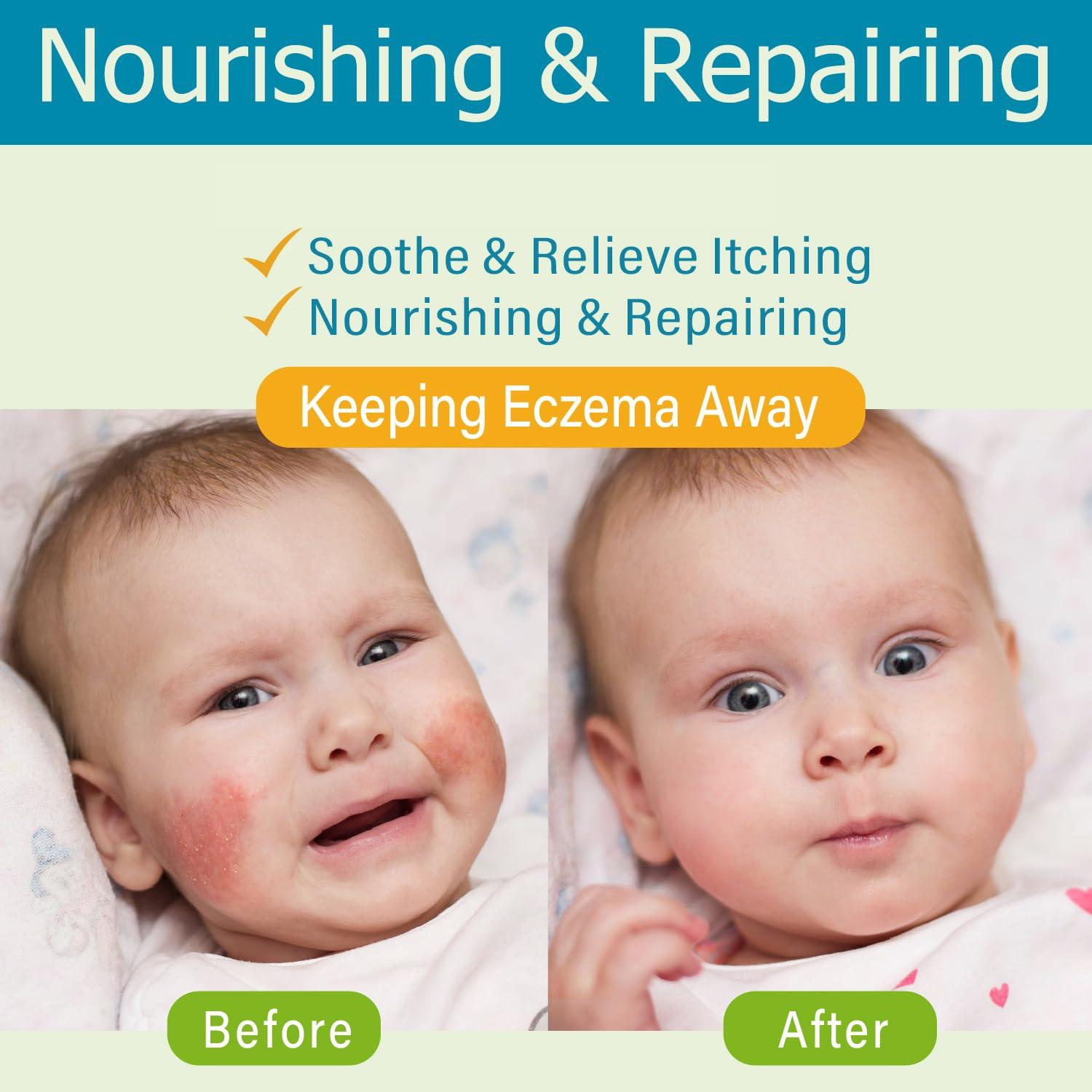 Crema para Eccema Infantil AOAO 100ml - Hipoalergénica y Nutritiva