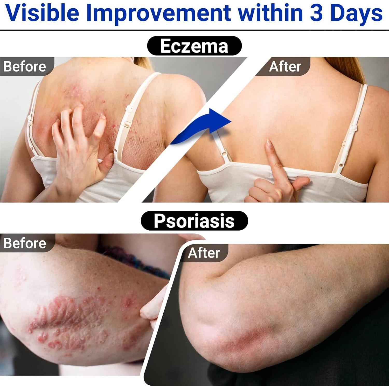 Crema para Eczema LMNOOP 50g - Alivio para Piel Irritada