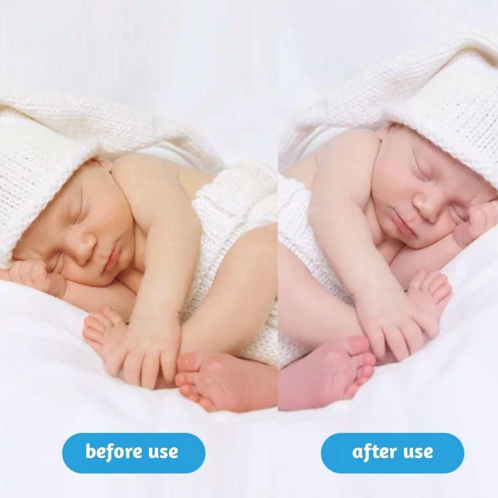 Lámpara de Terapia de Ictericia Neonatal Stickfrease 144 LED