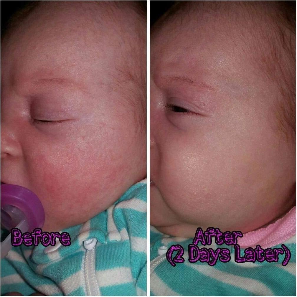 Spray Probiotico Tópico BabyBiotics 113g - Hipoalergénico, Vegano