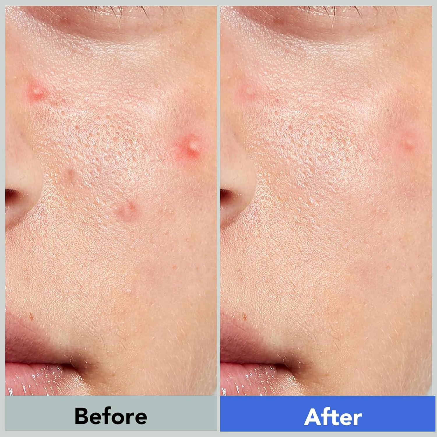 Parches Hidrocoloides para Granos Qmakup - 360 Unidades