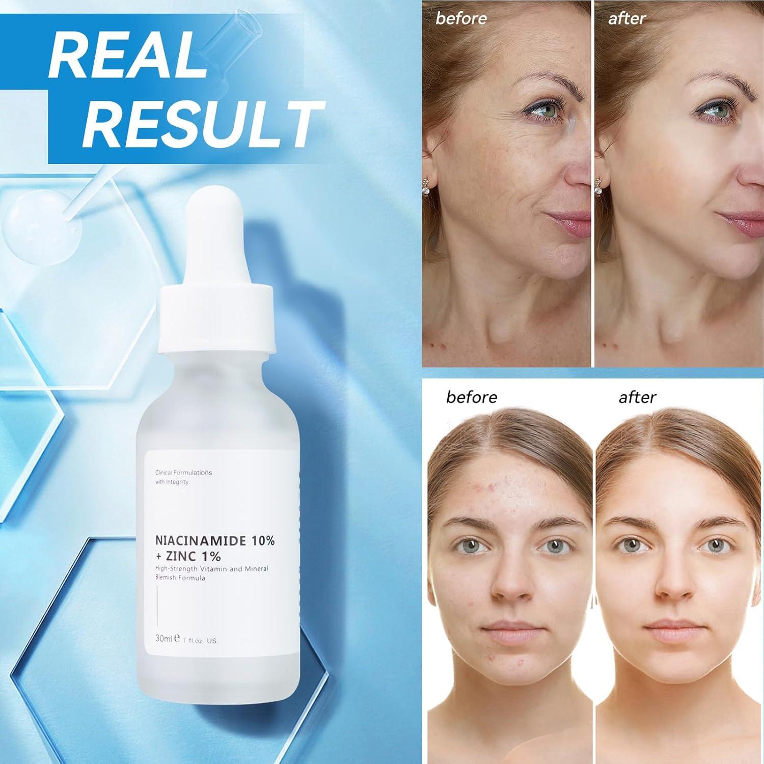 Suero Facial Niacinamida 10% + Zinc 1% 30ml - Control de Aceite y Acné