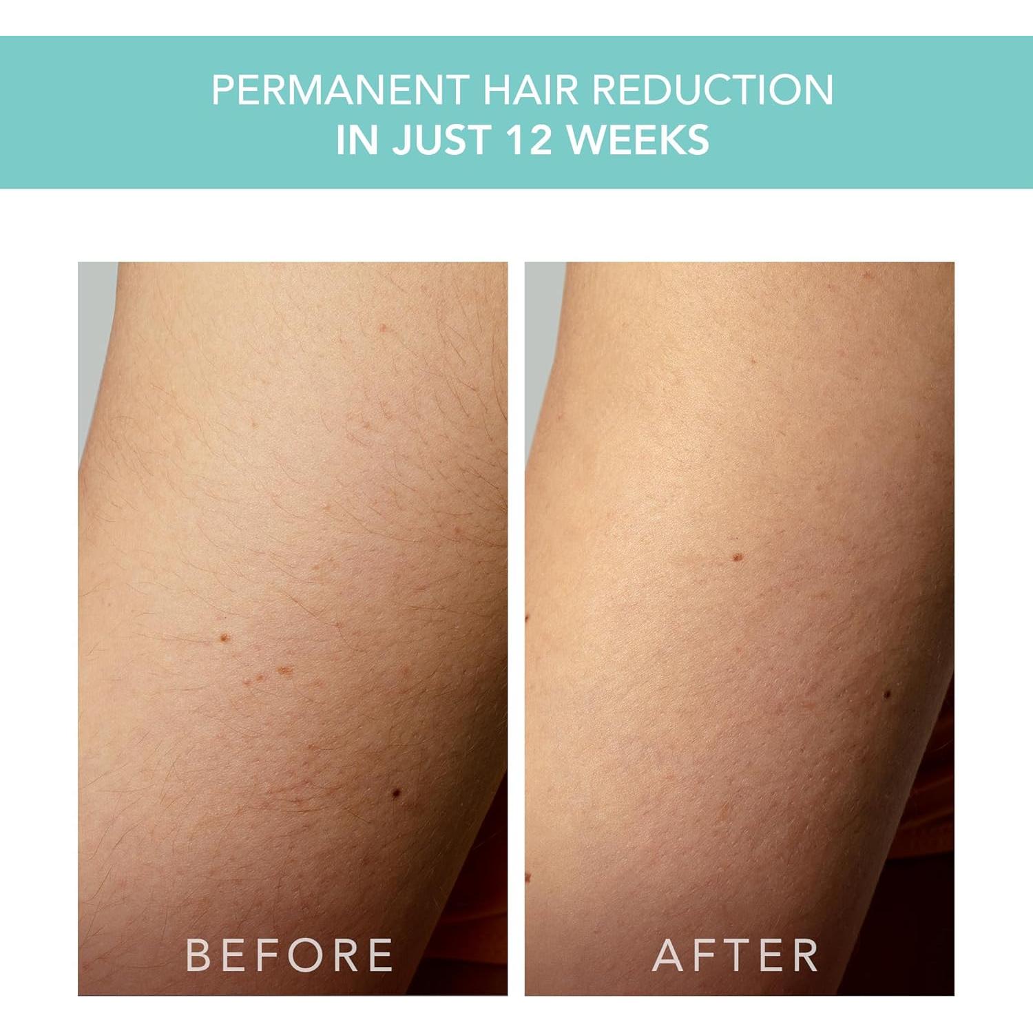 Dispositivo IPL FOREO PEACH 2 go - Eliminación de Vello Indolora