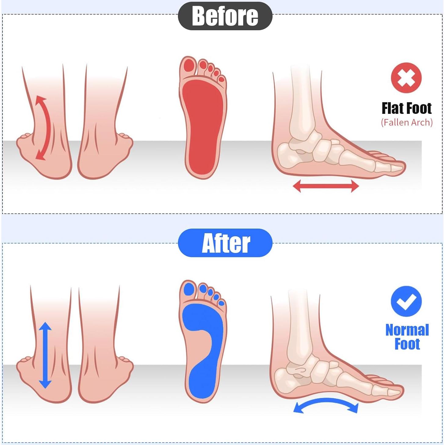 Corrector de Juanetes Utypee - Entrenador de Pies Azul