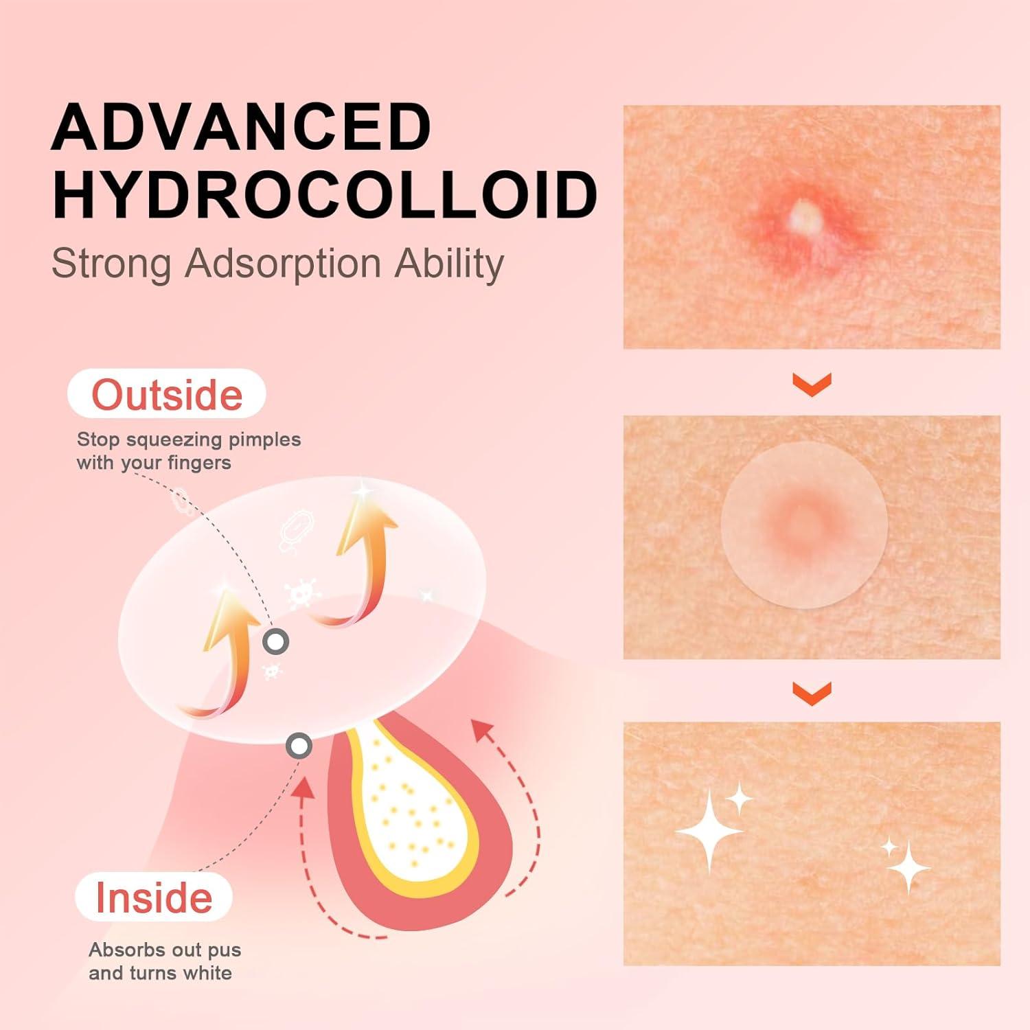 Parches para Granos AVJONE Hidrocoloide 144 Unidades