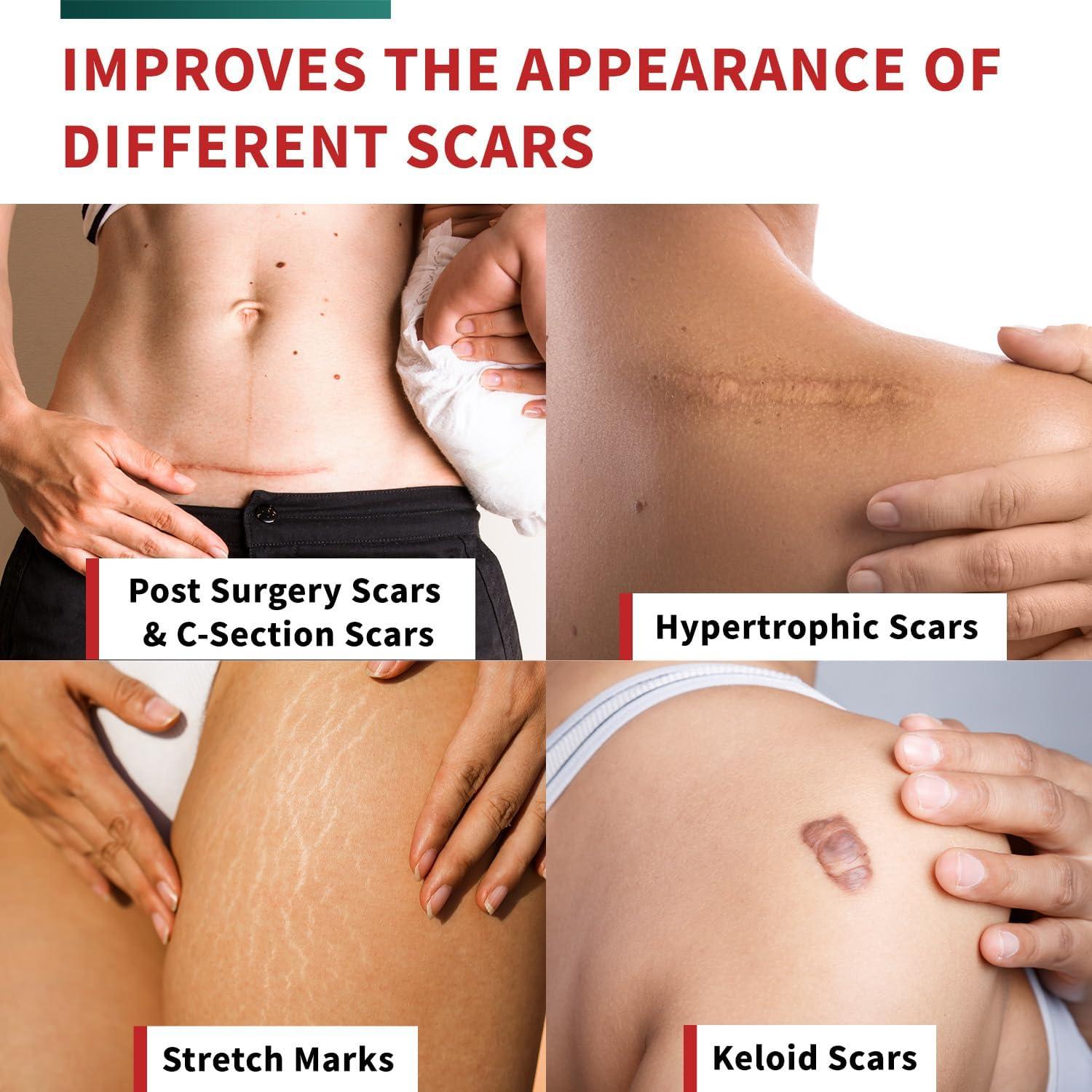 Cinta de Cicatriz de Silicona Protect Life 4.06 cm x 299.72 cm