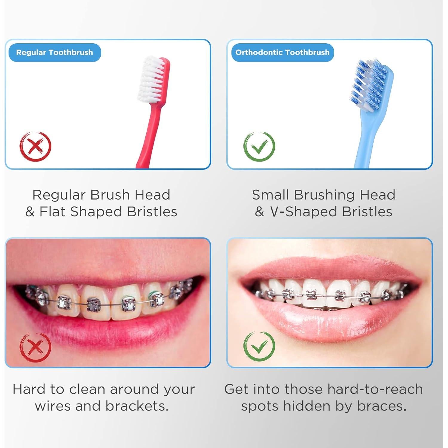 Cepillo de Dientes Ortodóntico Fremouth en Forma de V - 6 Unidades