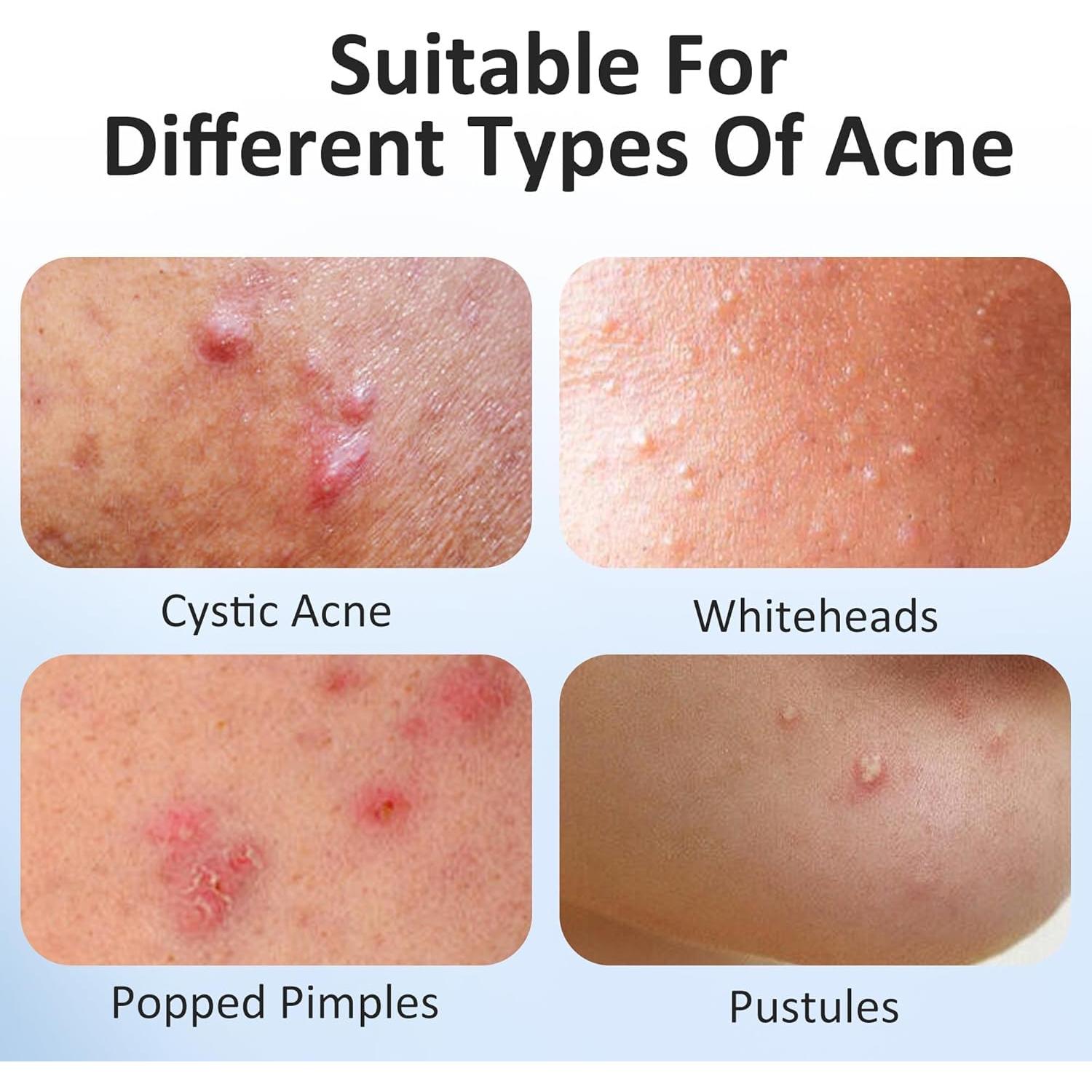 Parche Estrella para Espinillas MAXKYLUX - 4 Tamaños Hidrocoloide