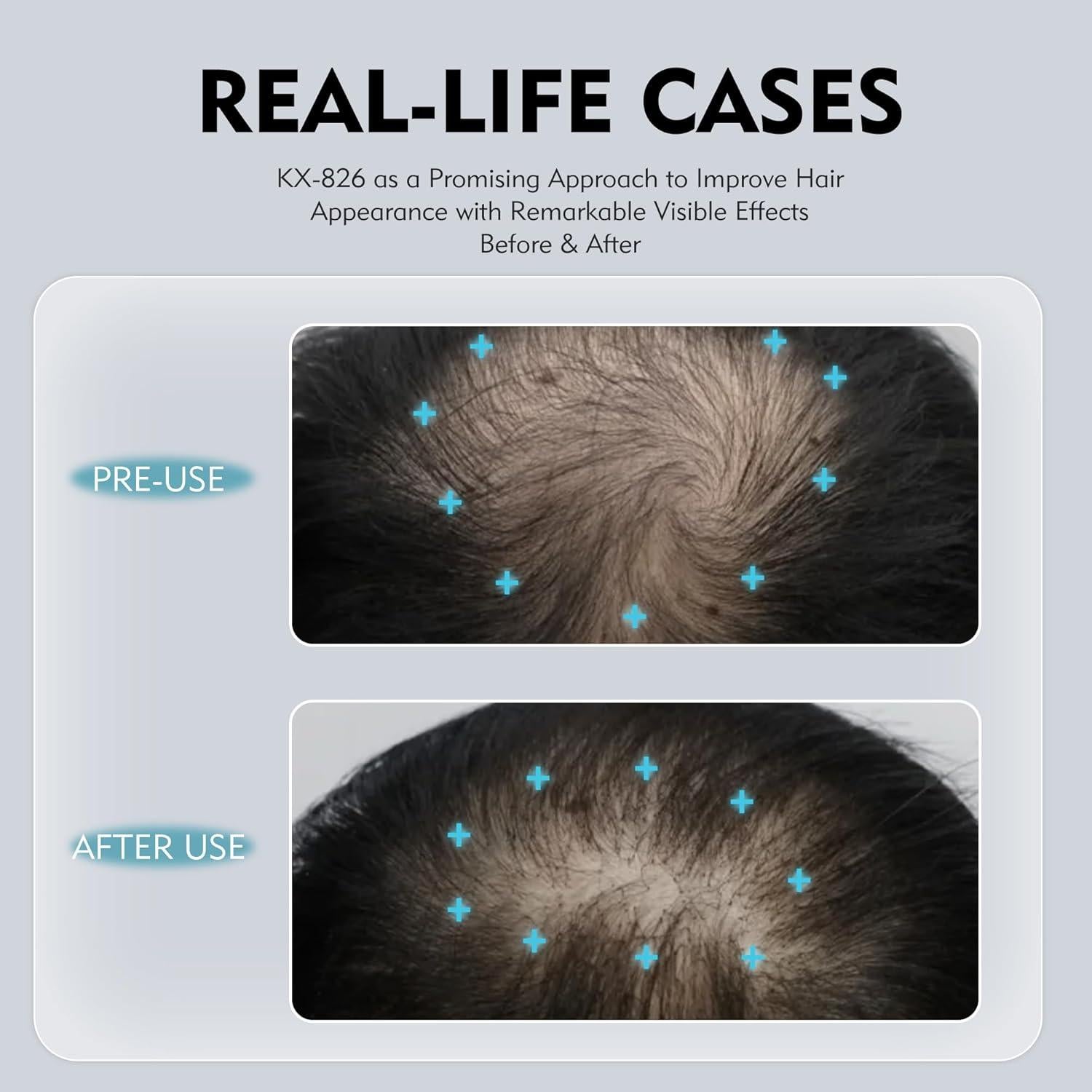 Kintor Spray Crecimiento Cabello 60ml - Bloqueador DHT 0.5%