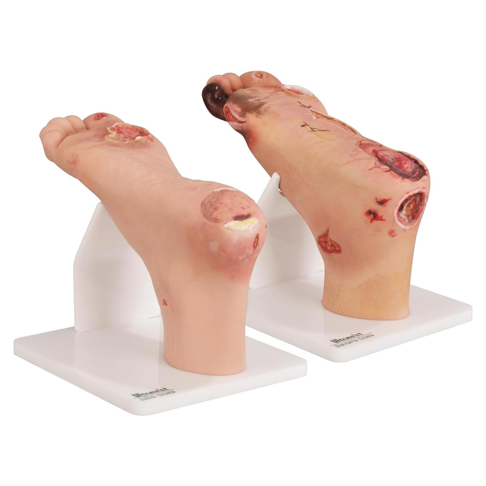 Conjunto de Ulcera Diabética Ultrassist - Modelo Clínico Preciso