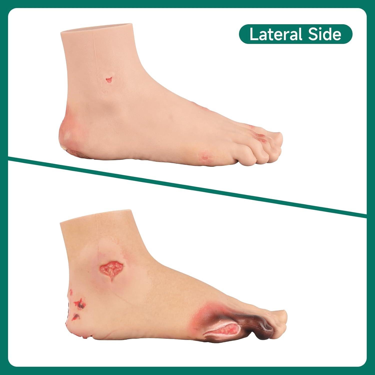 Conjunto de Ulcera Diabética Ultrassist - Modelo Clínico Preciso