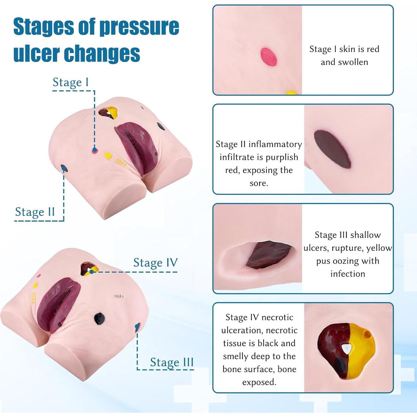Modelo de Úlcera por Decúbito JNMFTD - 4 Etapas Realistas