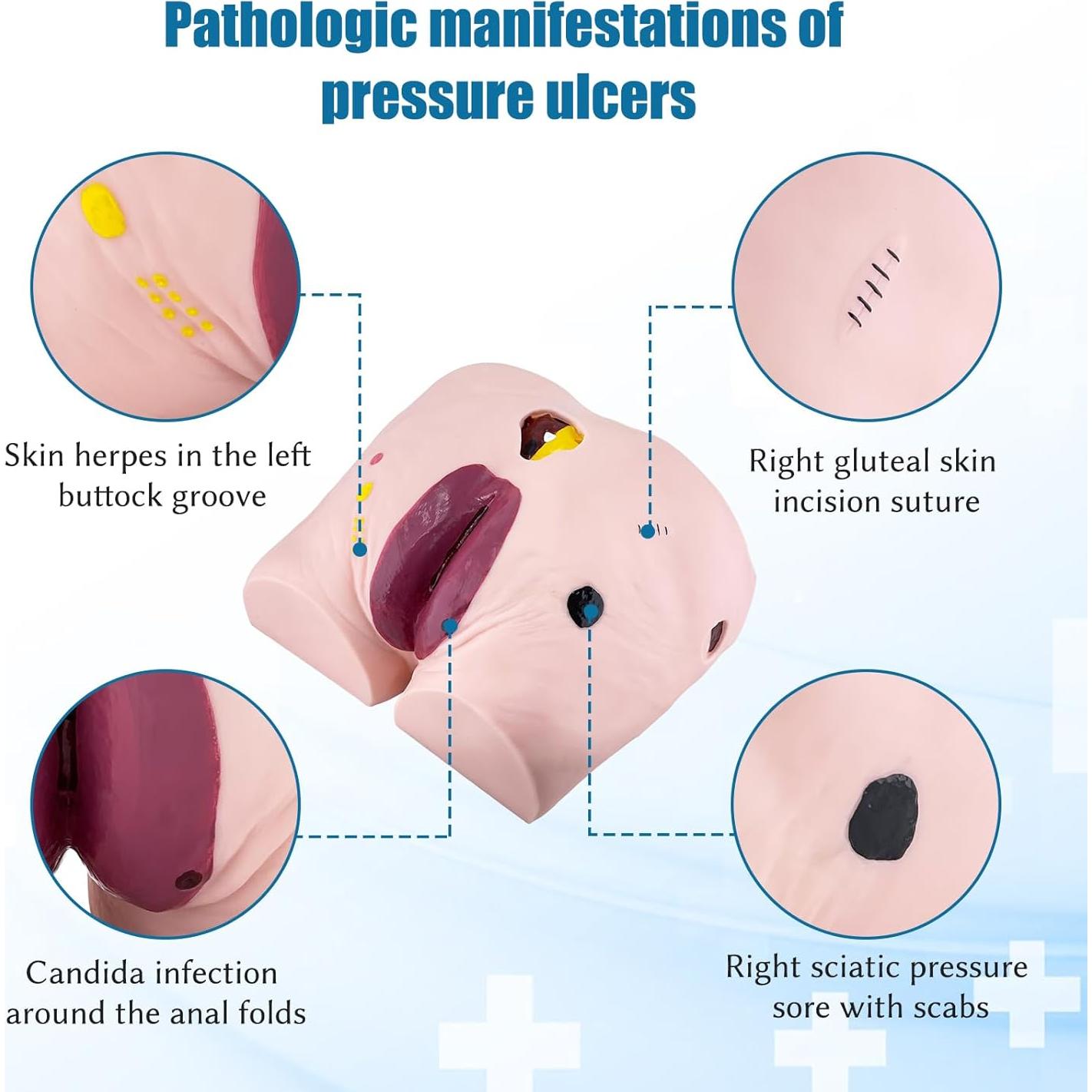 Modelo de Úlcera por Decúbito JNMFTD - 4 Etapas Realistas