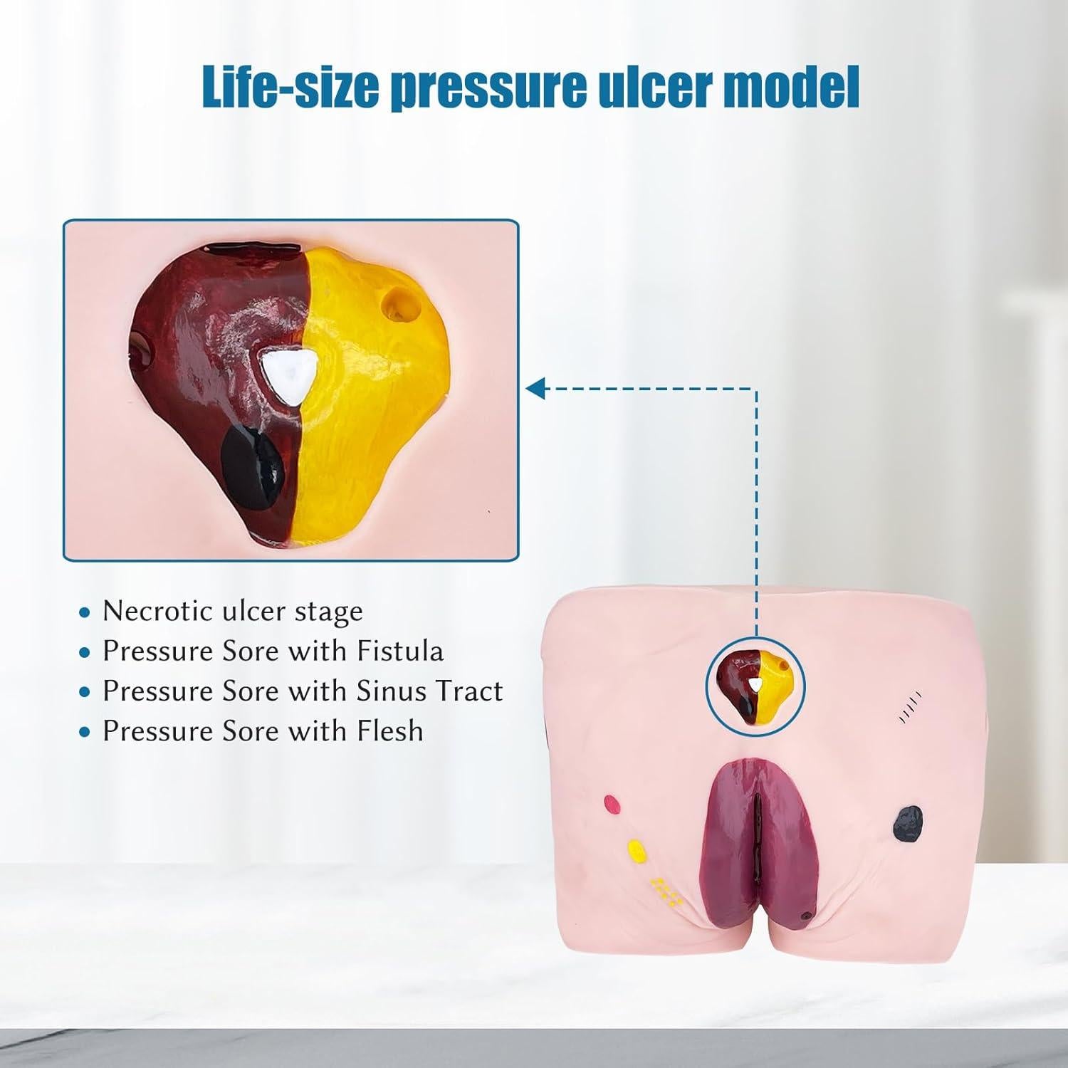 Modelo de Úlcera por Decúbito JNMFTD - 4 Etapas Realistas