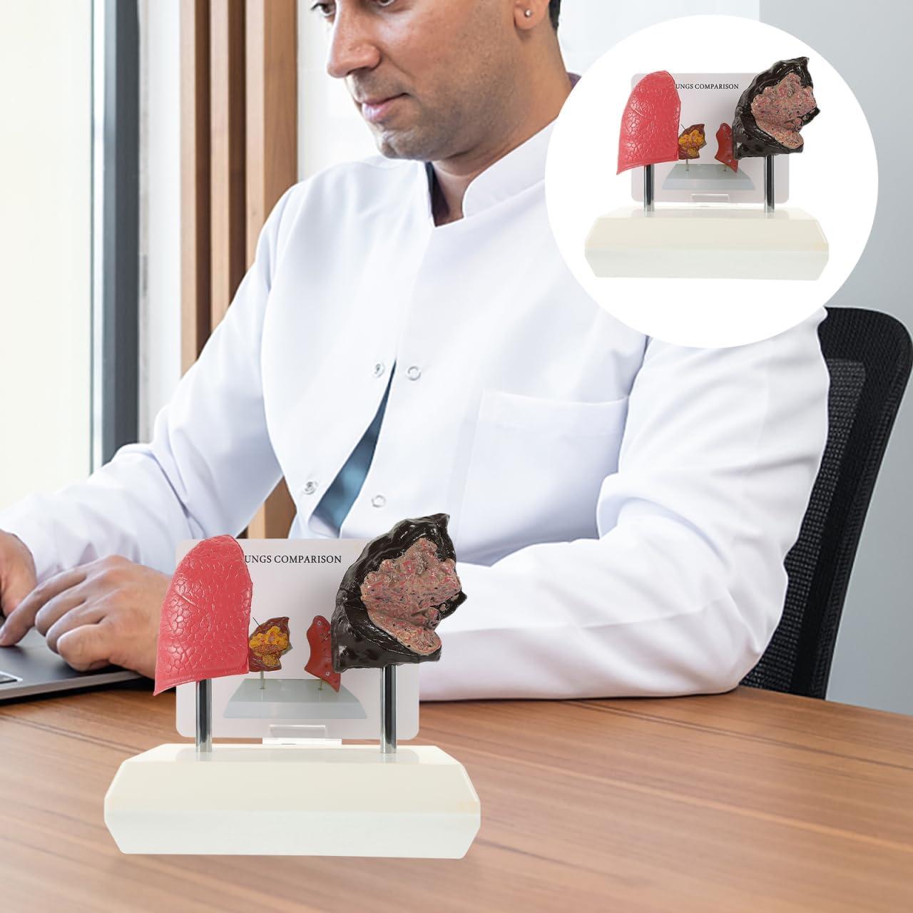 Modelo de Pulmón Fumador Cabilock - Anatomía Realista PVC 20cm