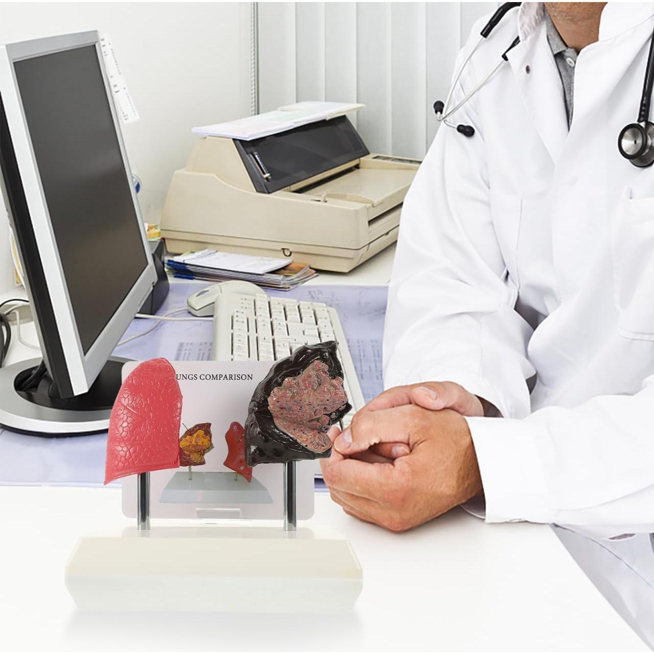 Modelo de Pulmón Fumador Cabilock - Anatomía Realista PVC 20cm