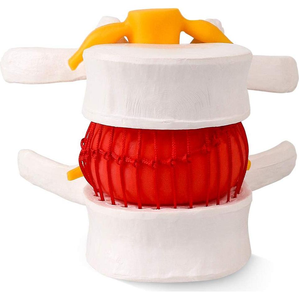 Modelo de Herniación del Disco Lumbar Humano YOOVEE 24 cm