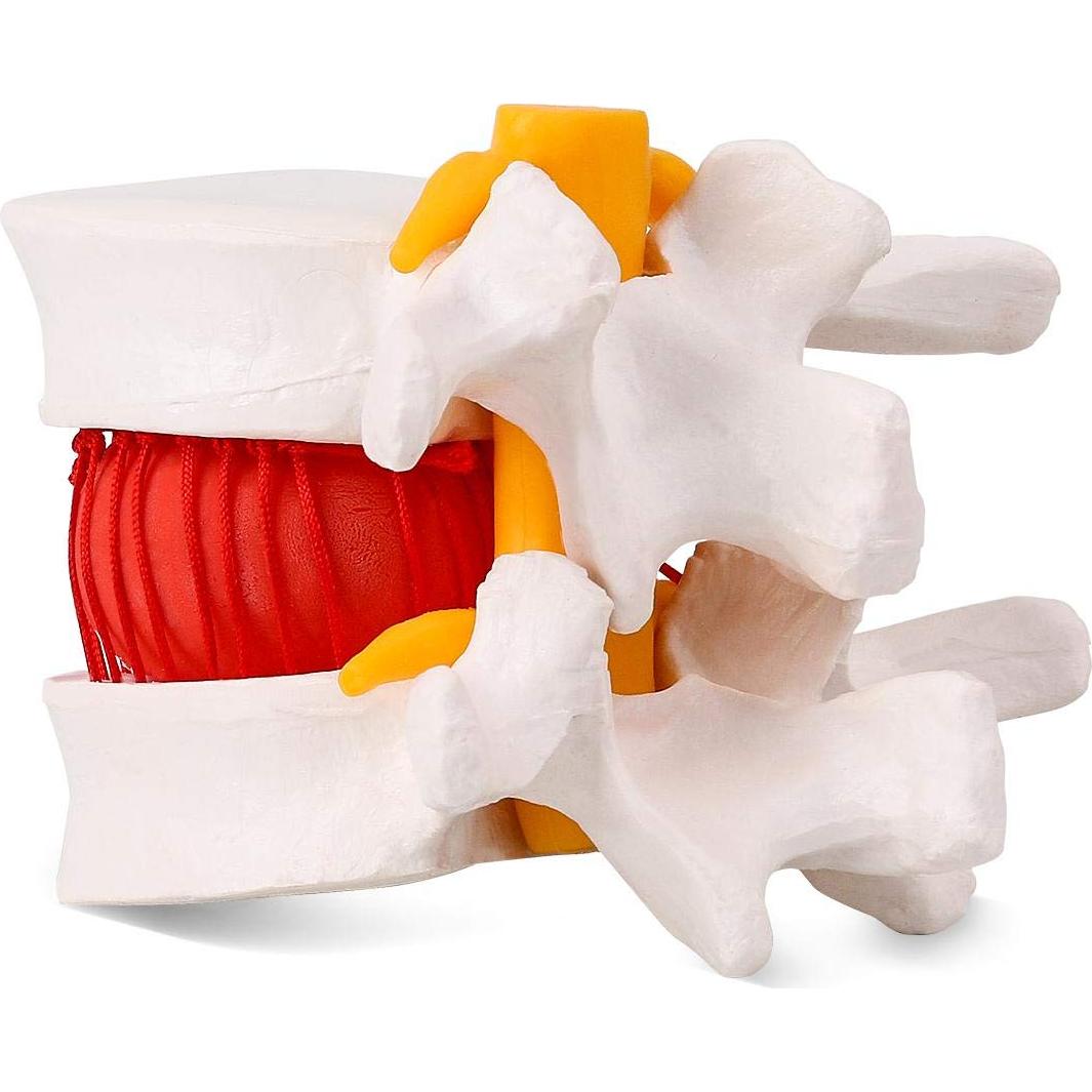 Modelo de Herniación del Disco Lumbar Humano YOOVEE 24 cm