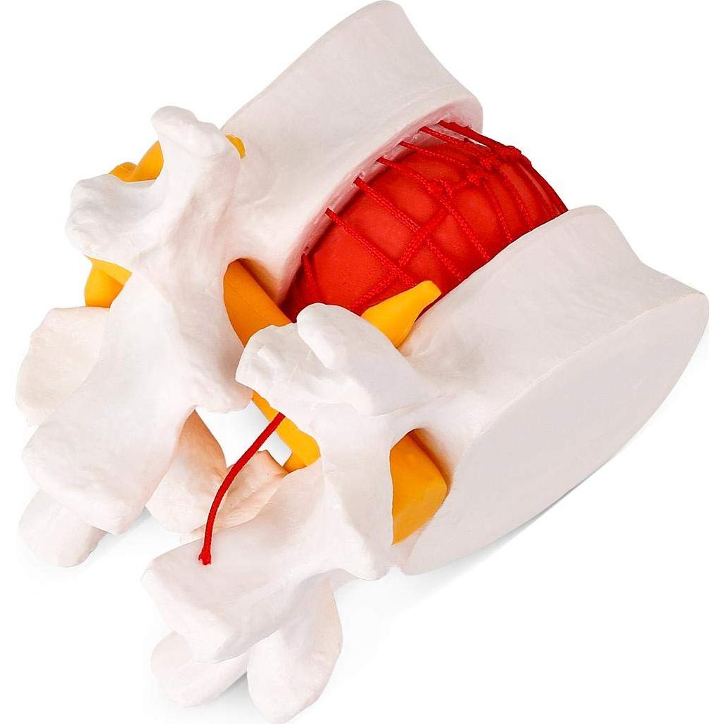 Modelo de Herniación del Disco Lumbar Humano YOOVEE 24 cm