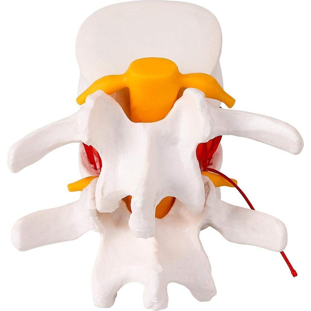 Modelo de Herniación del Disco Lumbar Humano YOOVEE 24 cm