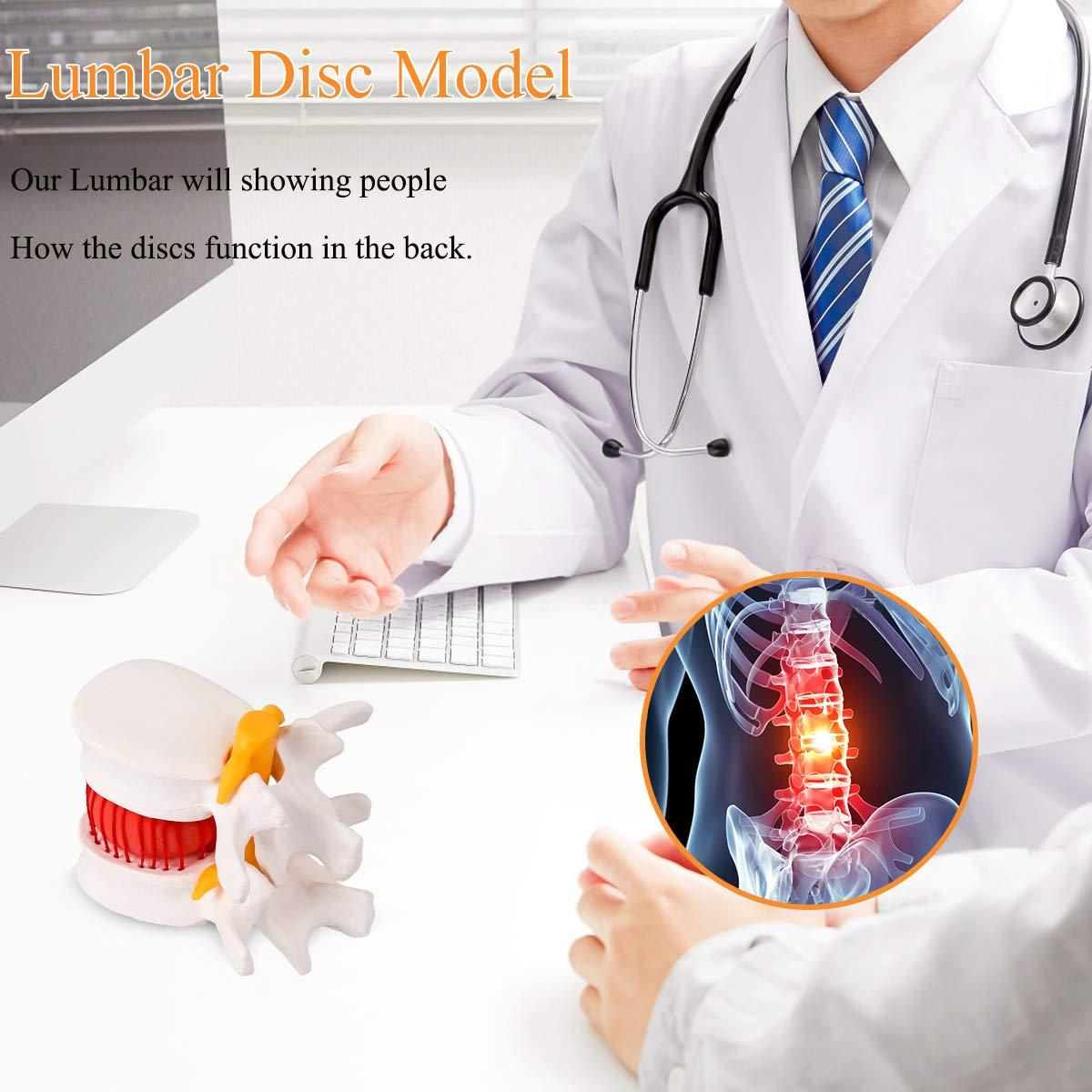 Modelo de Herniación del Disco Lumbar Humano YOOVEE 24 cm