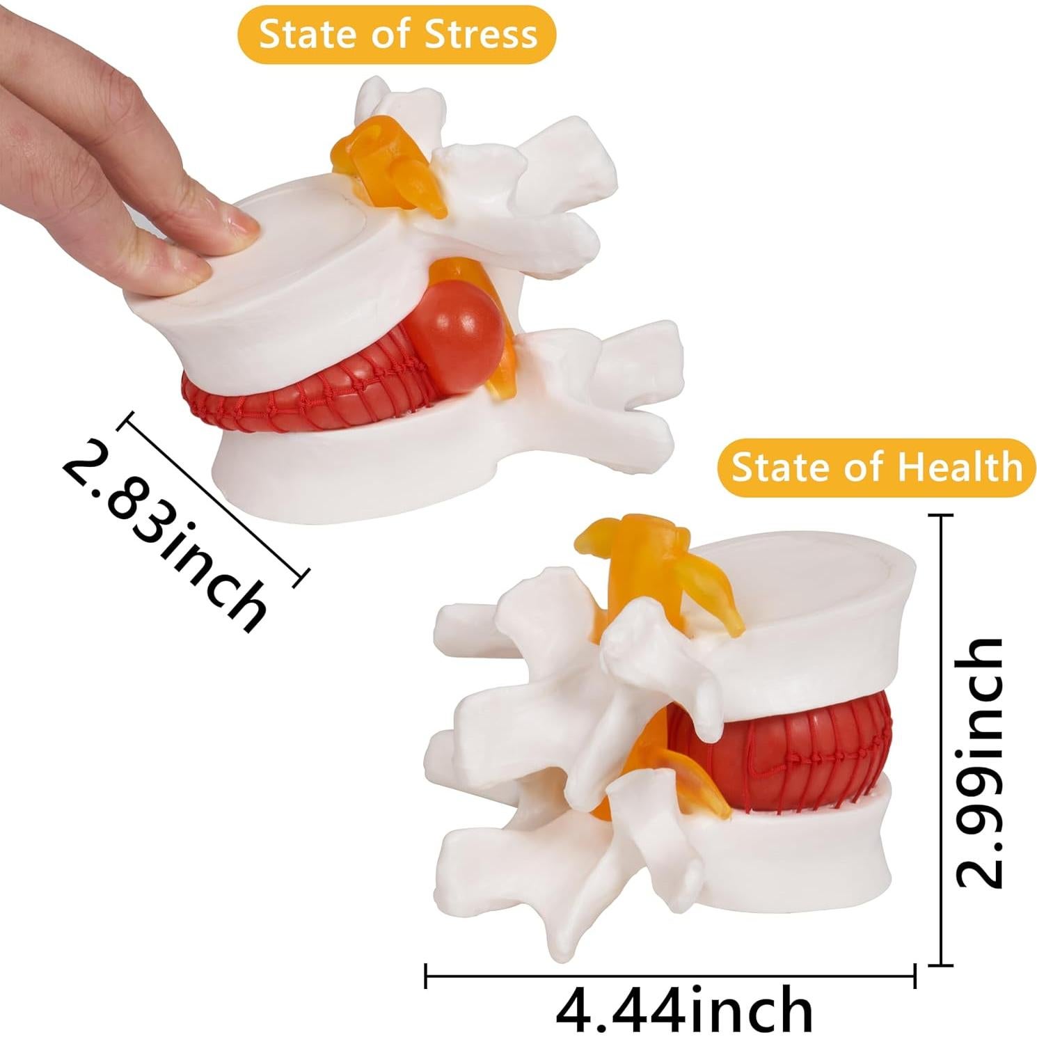 Modelo de Hernia de Disco Lumbar Breesky 1.5x Detalle
