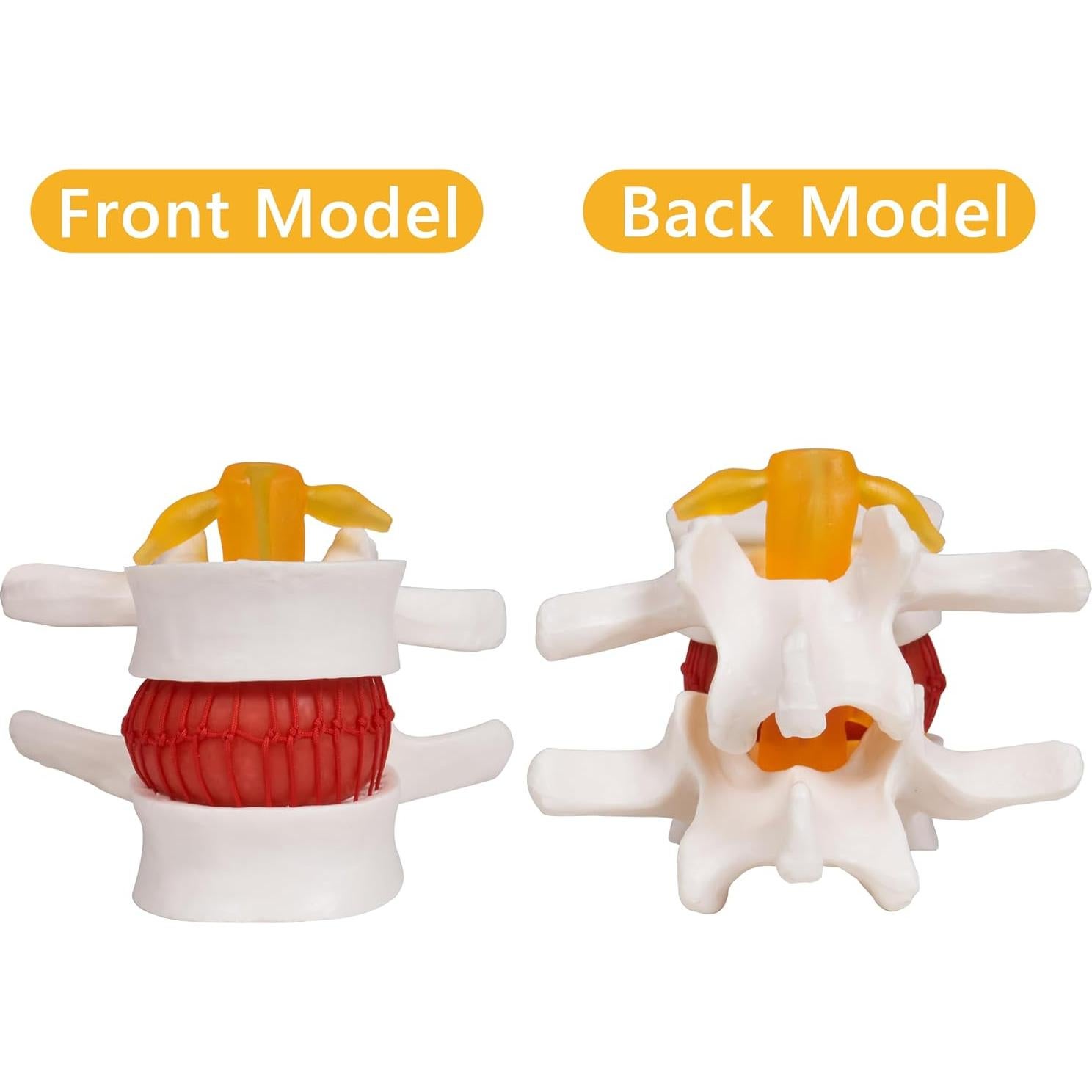 Modelo de Hernia de Disco Lumbar Breesky 1.5x Detalle