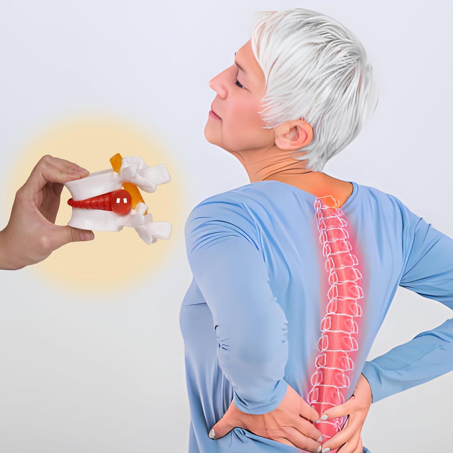 Modelo de Hernia de Disco Lumbar Breesky 1.5x Detalle