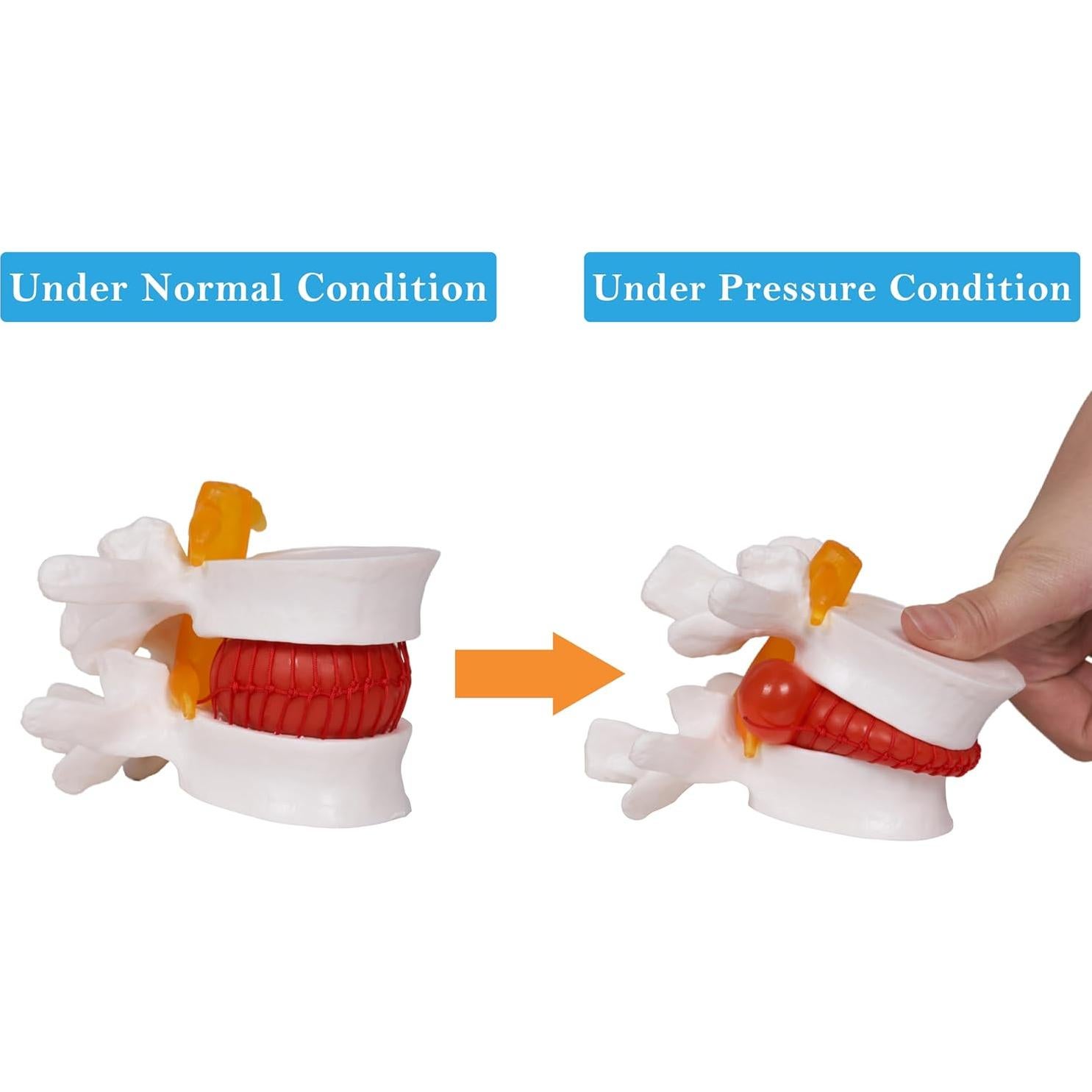 Modelo de Herniación de Disco Lumbar NLShan 1.5x Real
