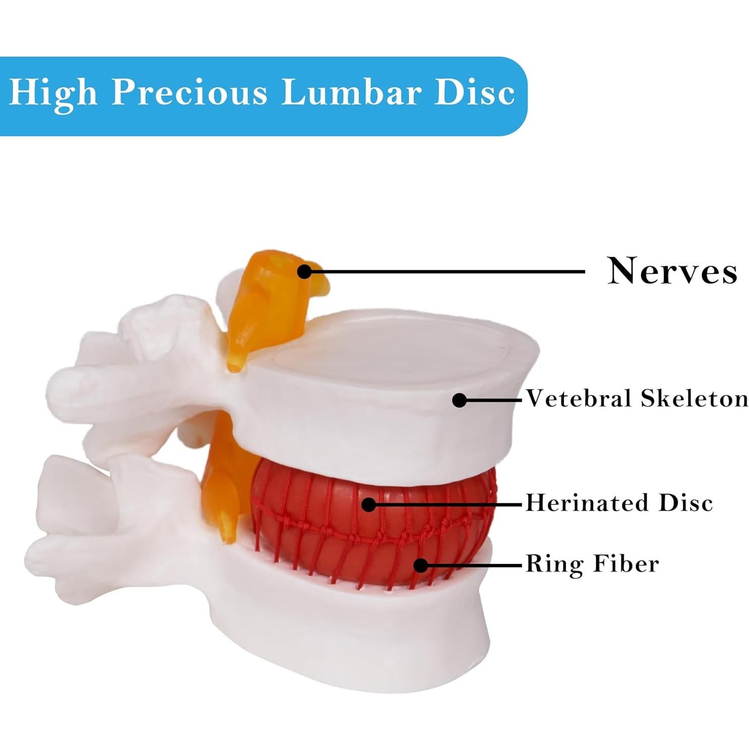Modelo de Herniación de Disco Lumbar NLShan 1.5x Real