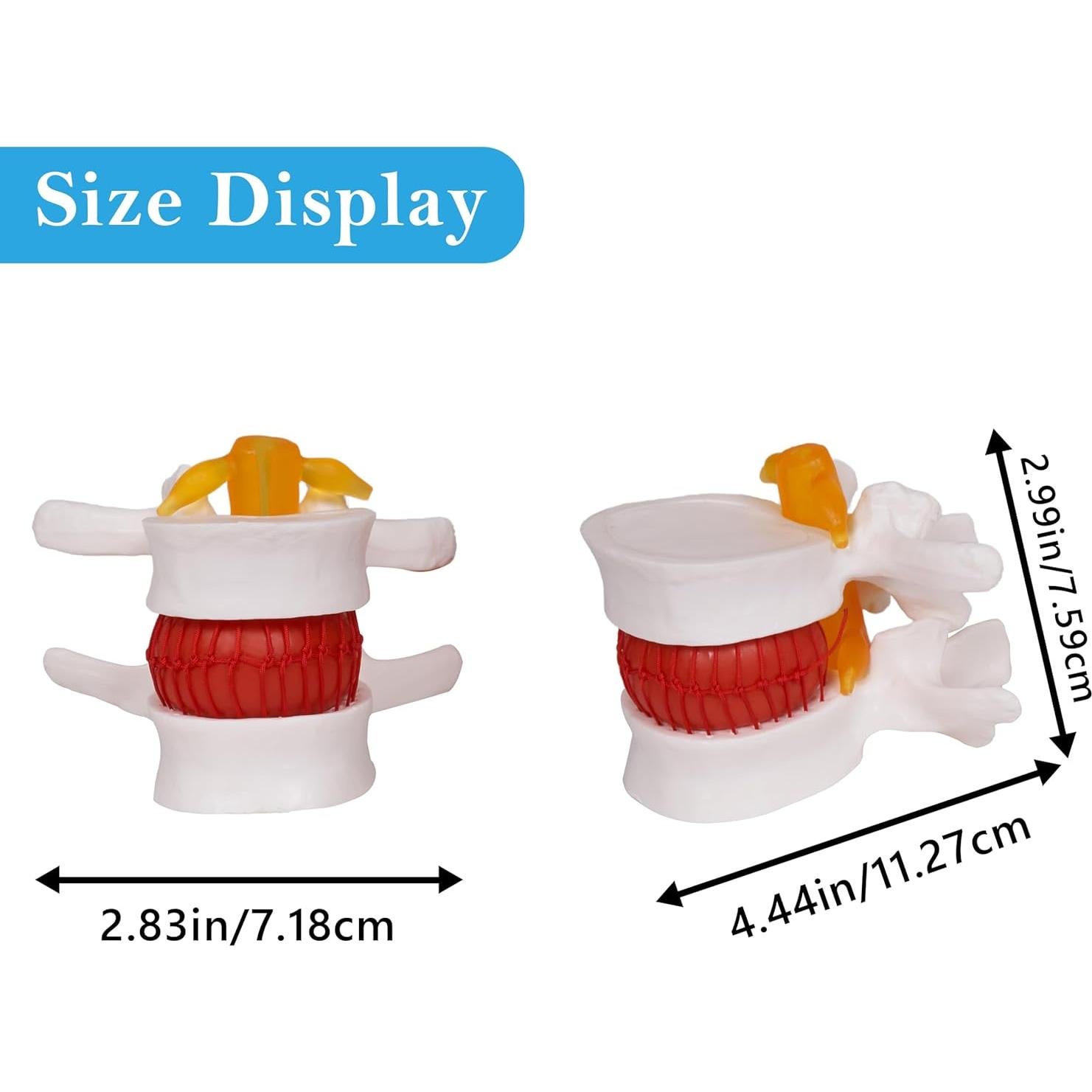 Modelo de Herniación de Disco Lumbar NLShan 1.5x Real
