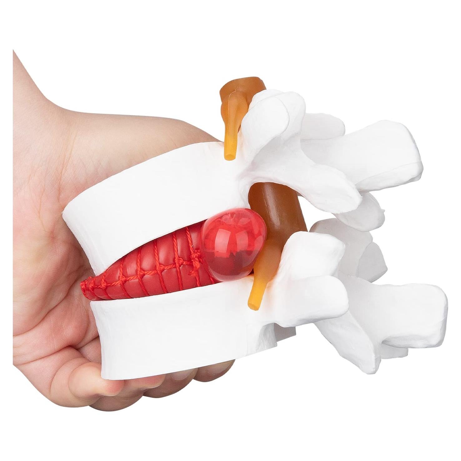 Modelo Anatómico de Herniación de Disco Lumbar 1.5X PVC