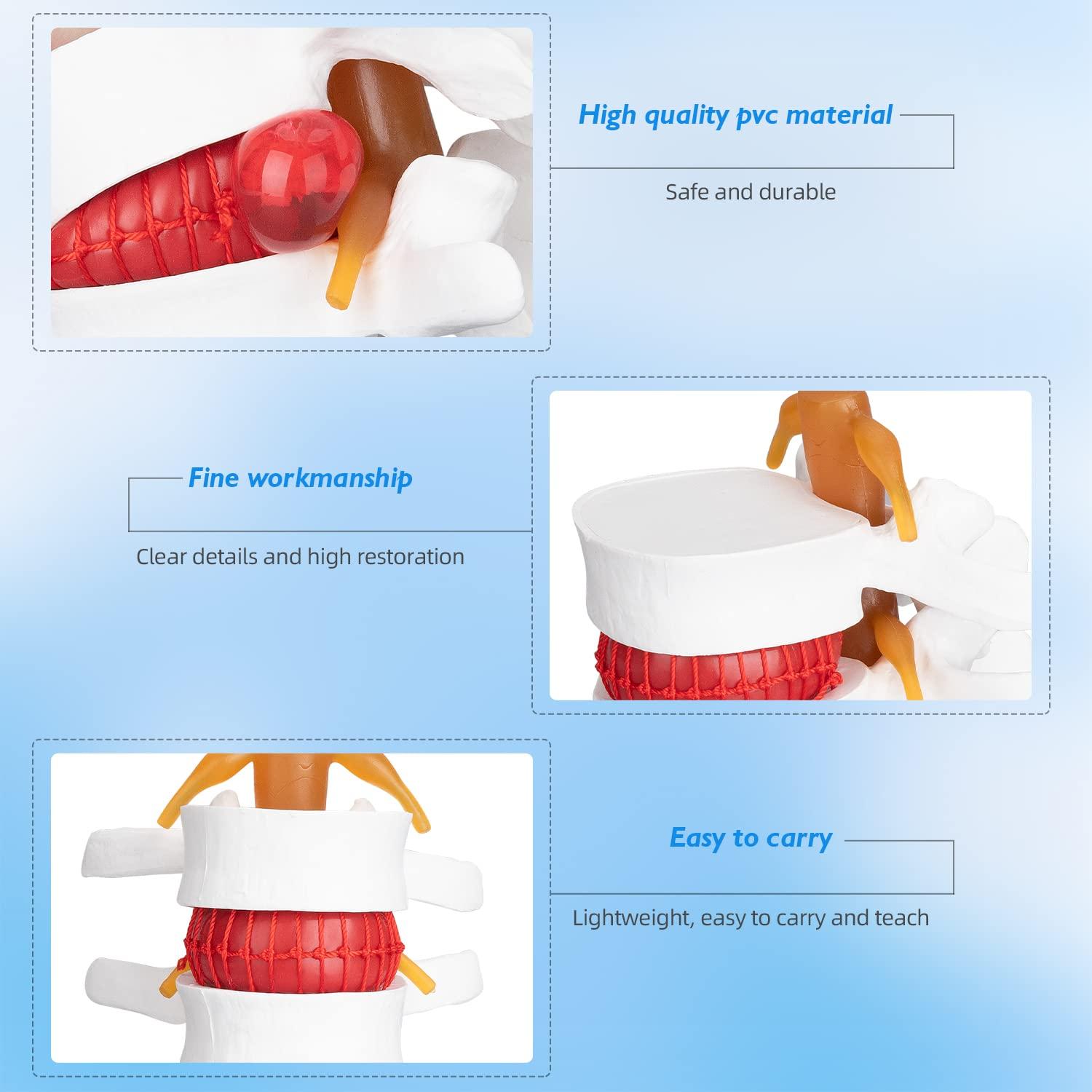 Modelo Anatómico de Herniación de Disco Lumbar 1.5X PVC