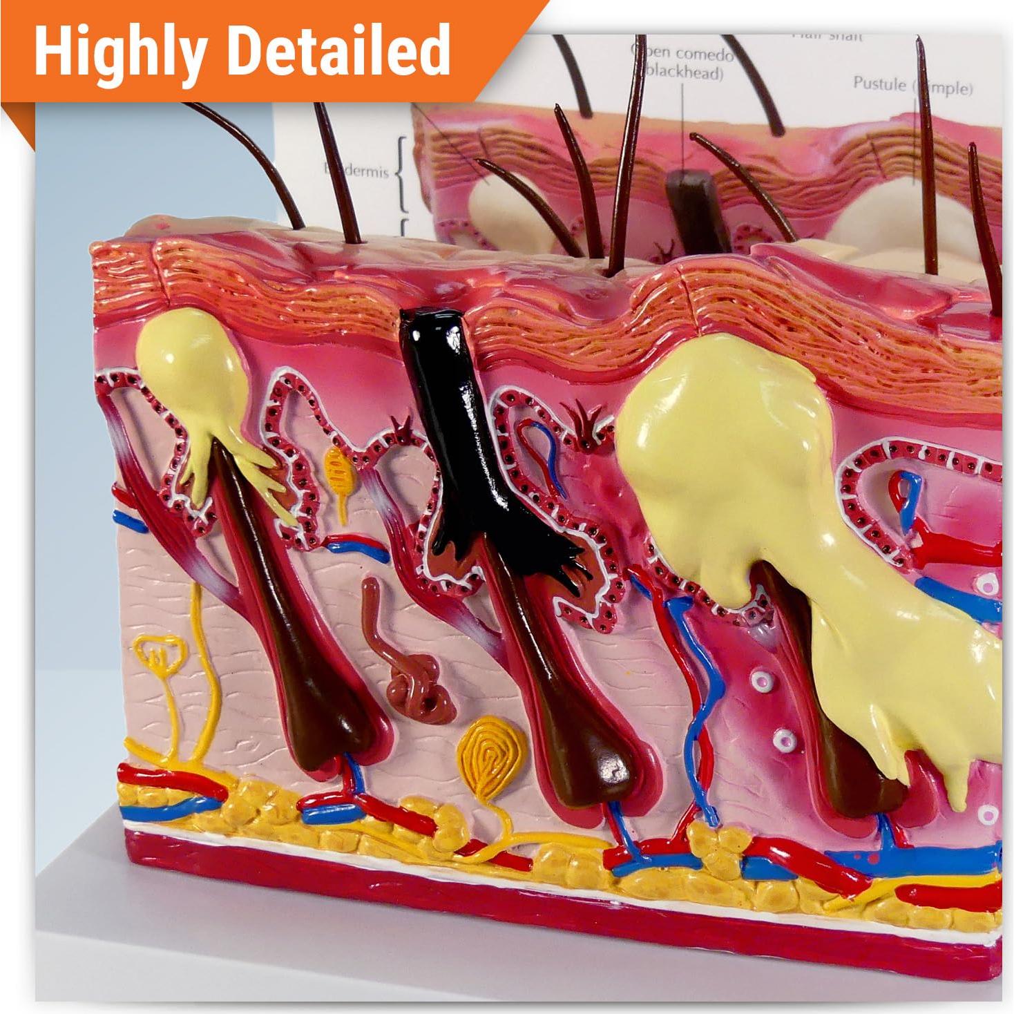 Modelo Anatómico de Acné GPI Anatomicals 15.24x15.24 cm