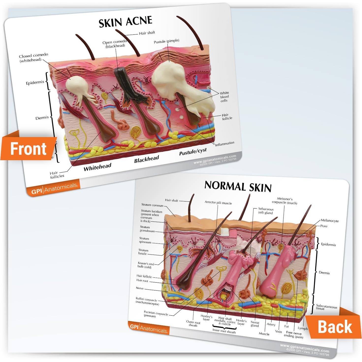 Modelo Anatómico de Acné GPI Anatomicals 15.24x15.24 cm