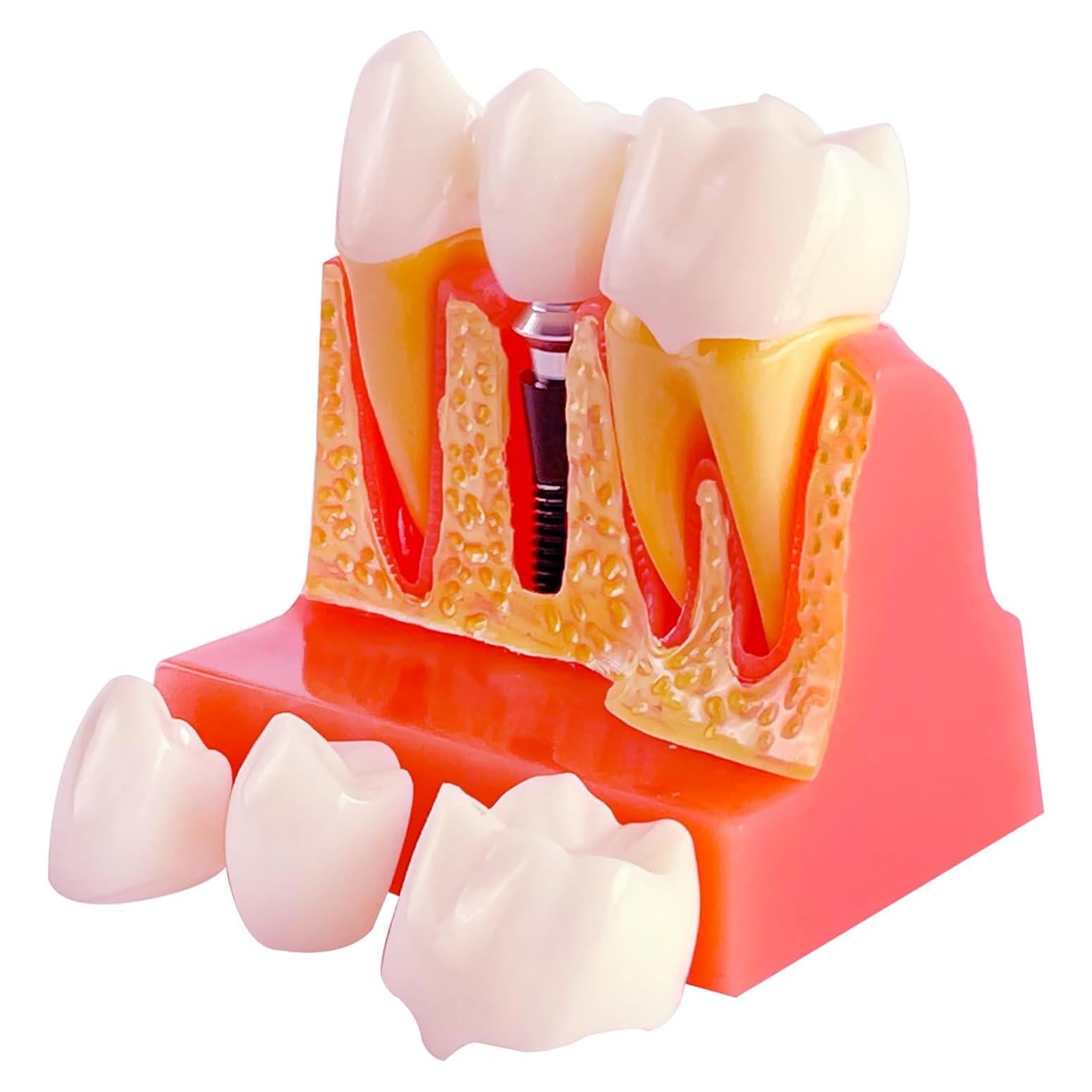 Modelo de Implante Dental Ceonam con Puente Removible 4x