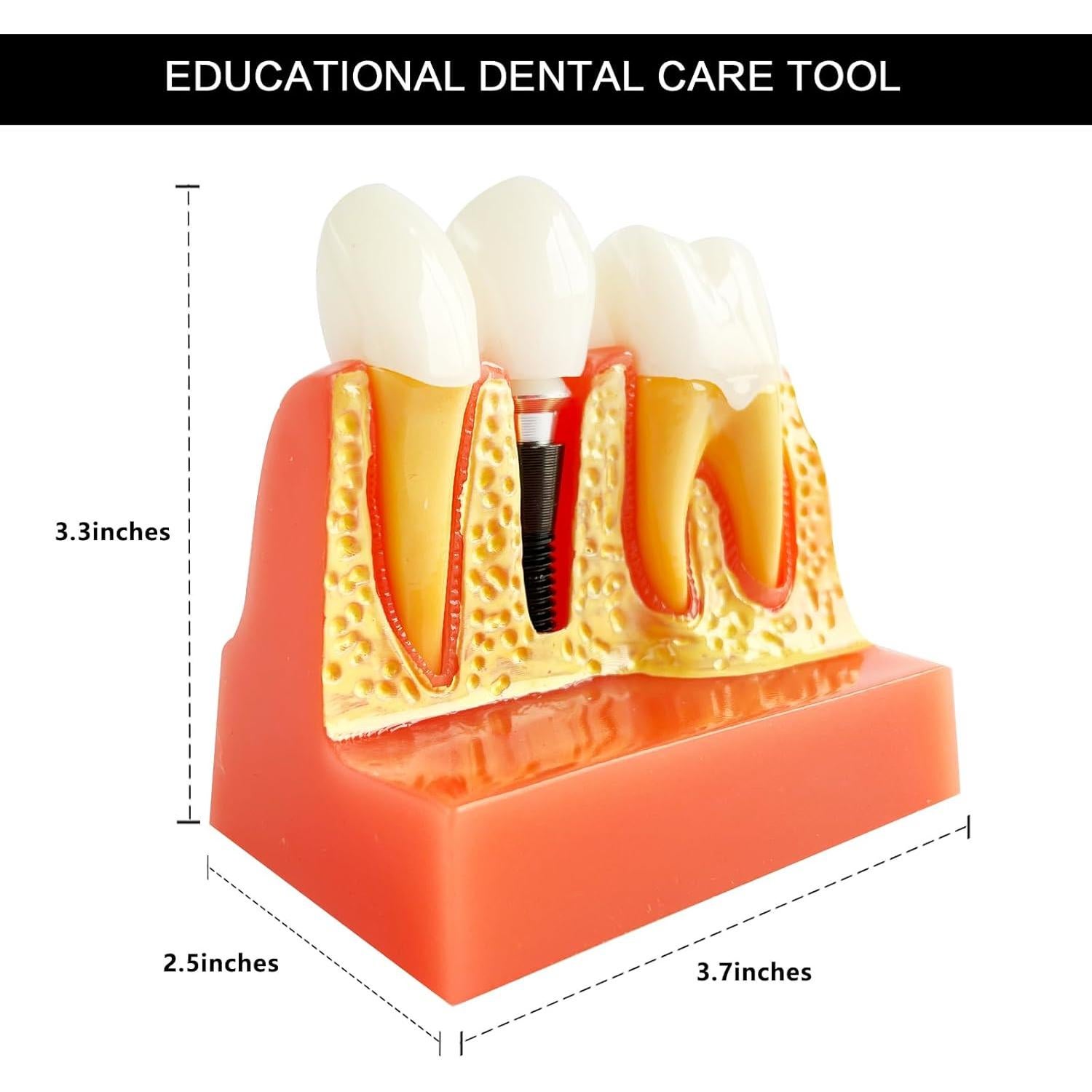 Modelo de Implante Dental Ceonam con Puente Removible 4x