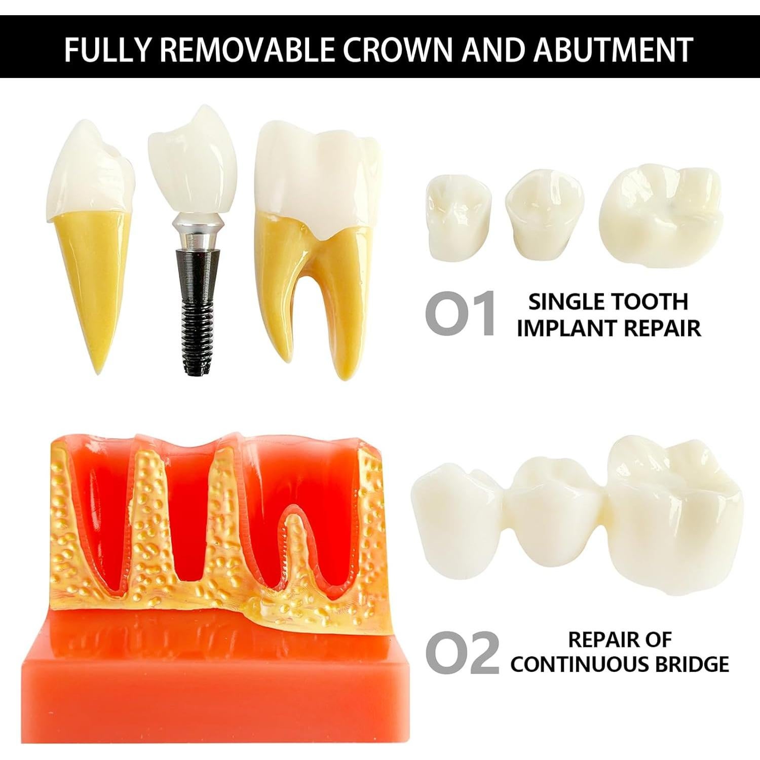 Modelo de Implante Dental Ceonam con Puente Removible 4x