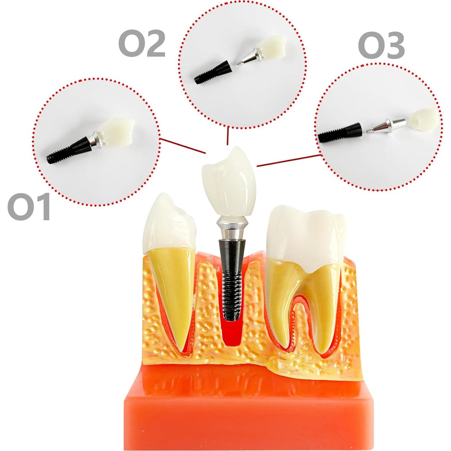 Modelo de Implante Dental Ceonam con Puente Removible 4x