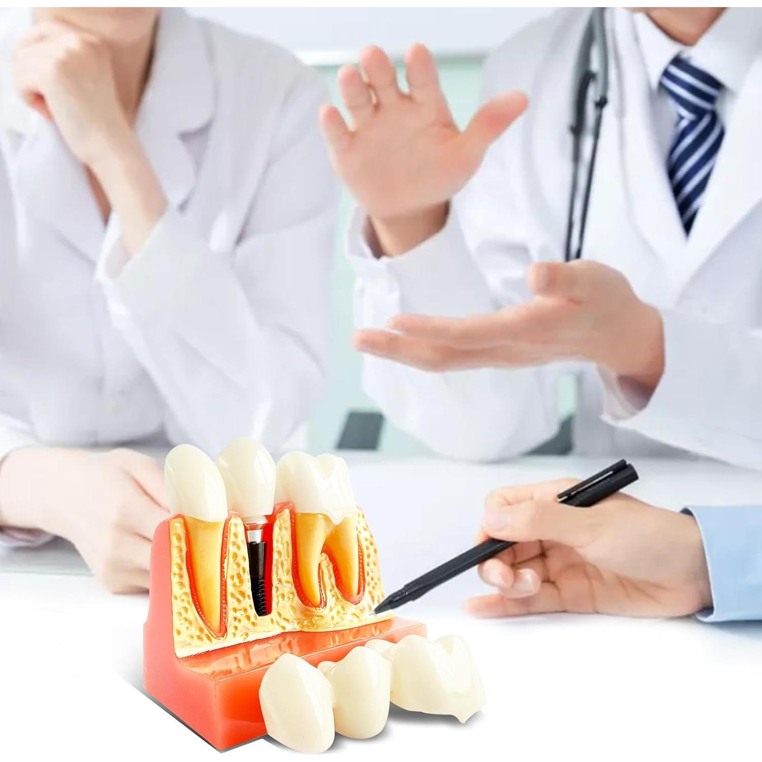 Modelo de Implante Dental Ceonam con Puente Removible 4x