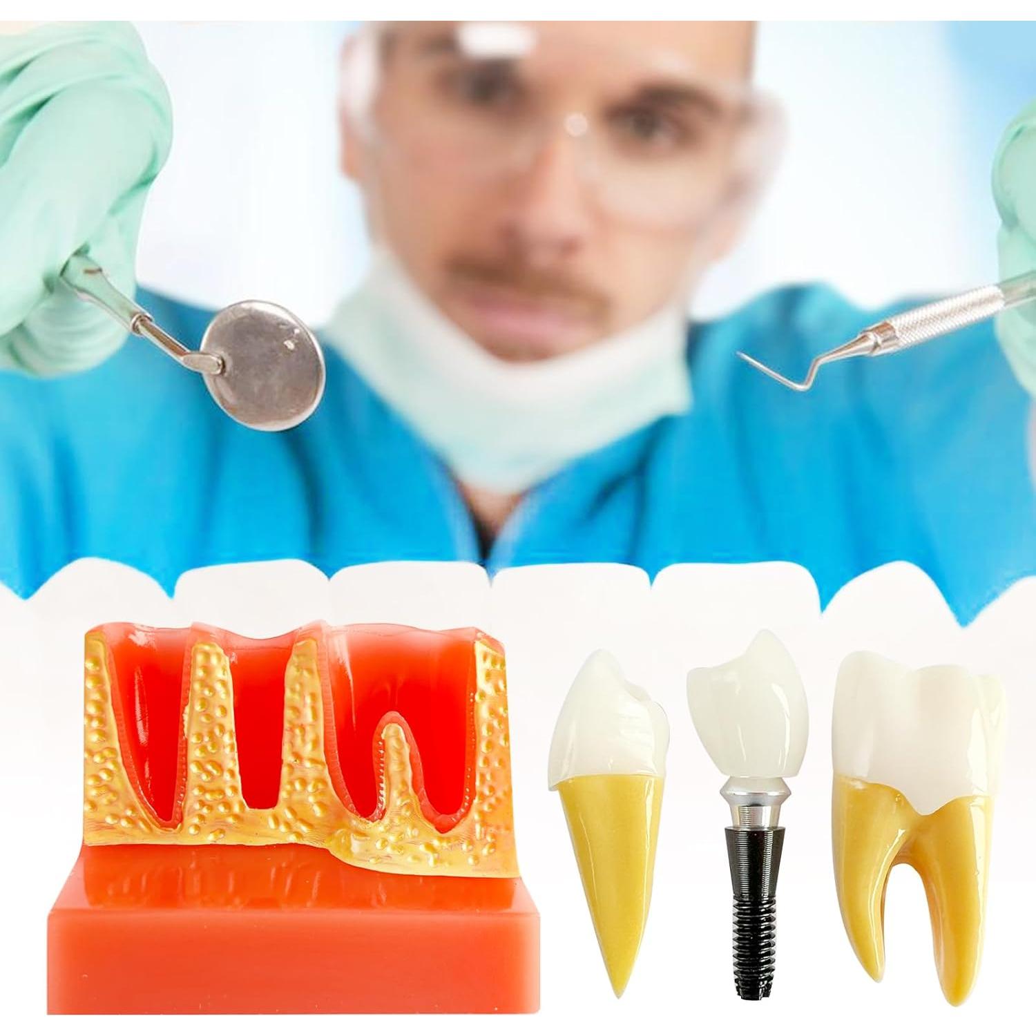 Modelo de Implante Dental Ceonam con Puente Removible 4x