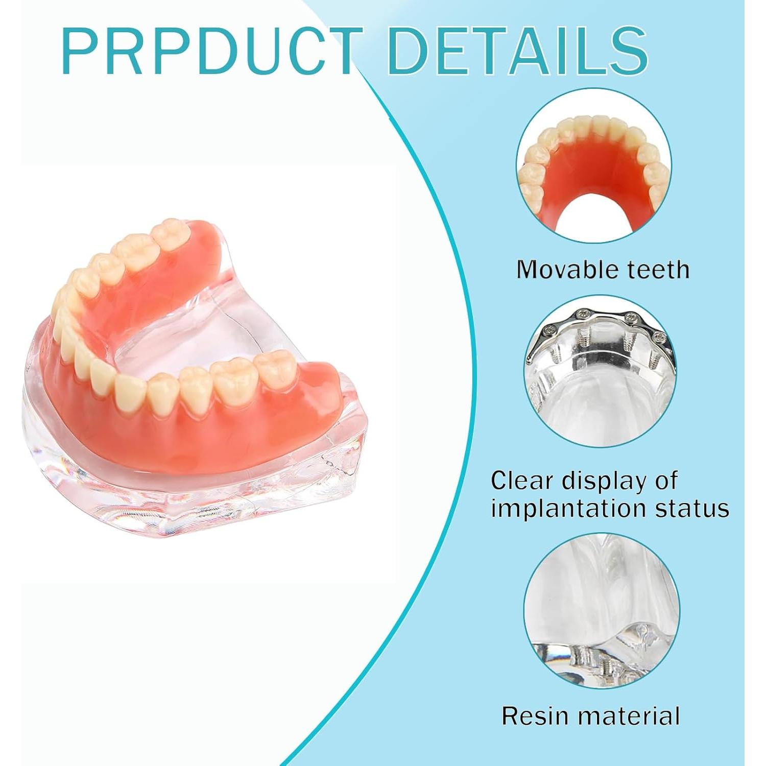 Modelo Dental Sobredentadura Desmontable Kouyot - Mandíbula Inferior
