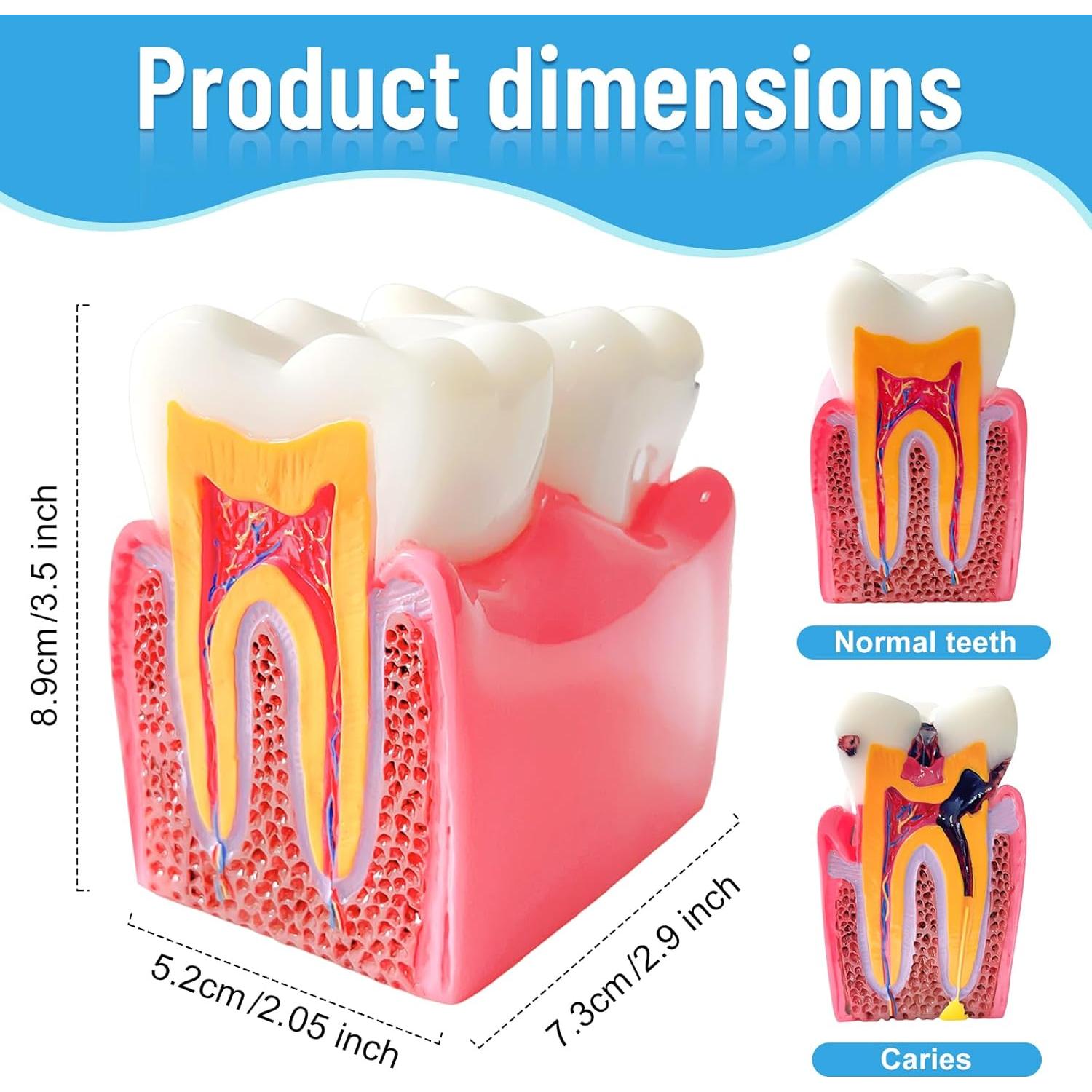 Modelo Educativo de Dientes de Caries Ceonam 8.6x7.6cm