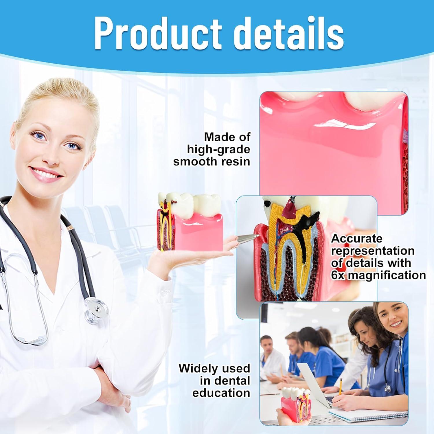 Modelo Educativo de Dientes de Caries Ceonam 8.6x7.6cm