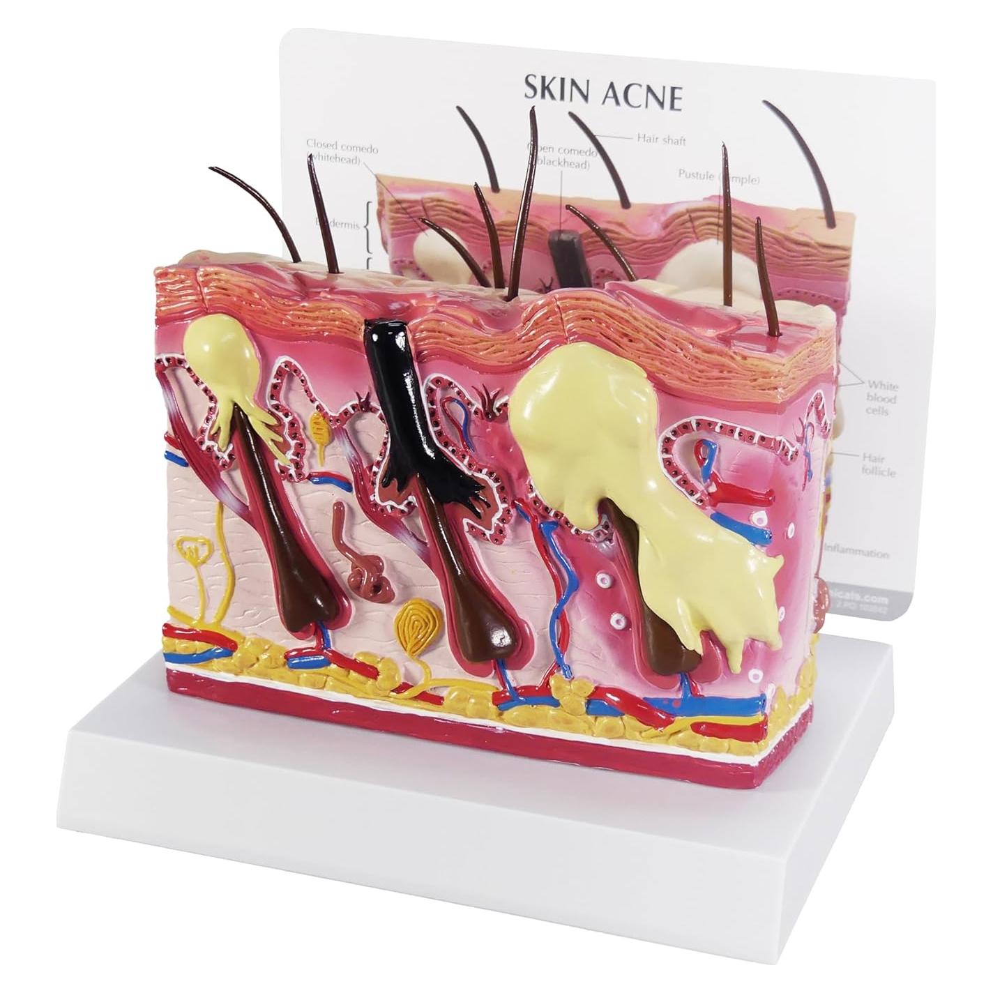 Modelo Anatómico de Piel con Acné GPI Anatomicals 18.42x18.42cm