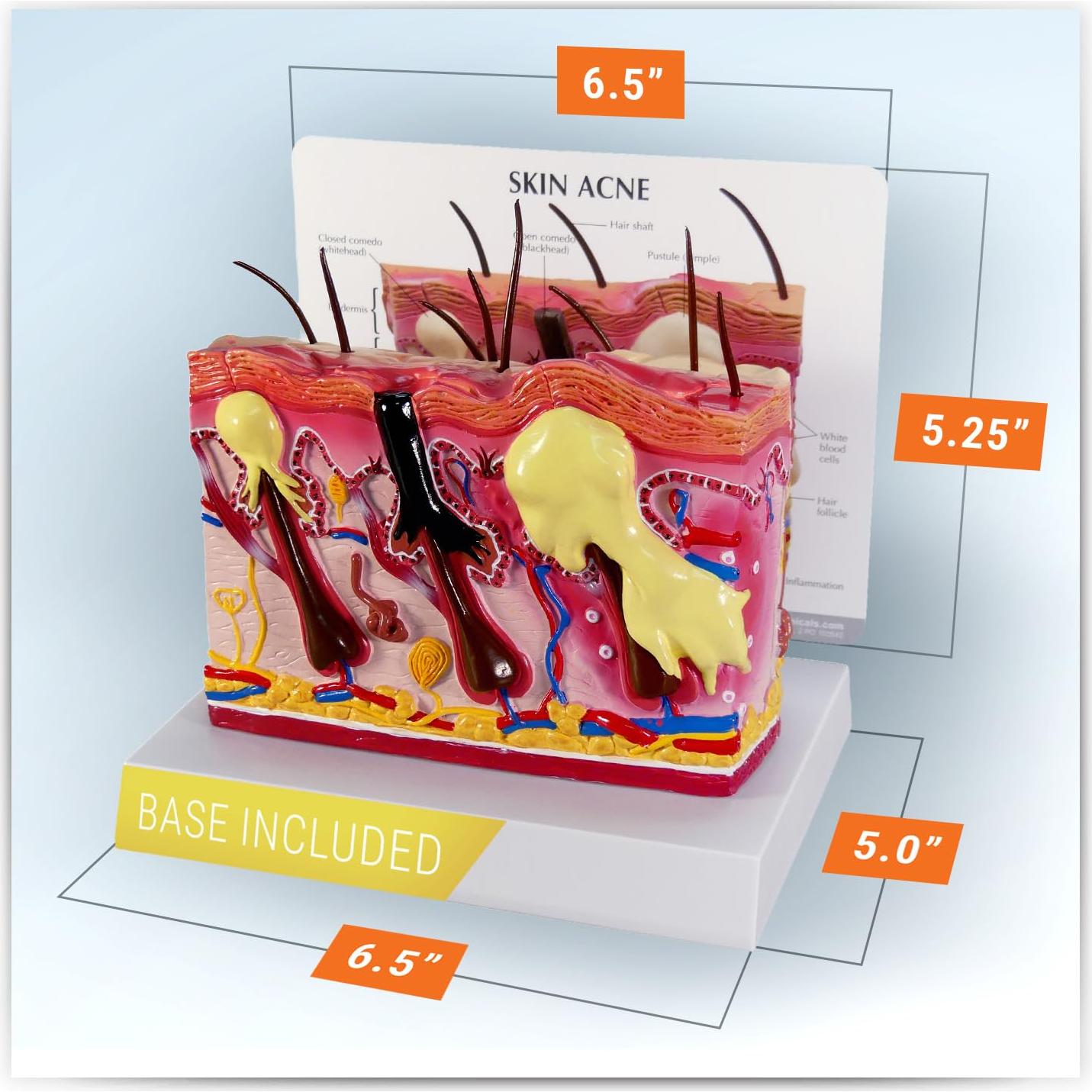 Modelo Anatómico de Piel con Acné GPI Anatomicals 18.42x18.42cm