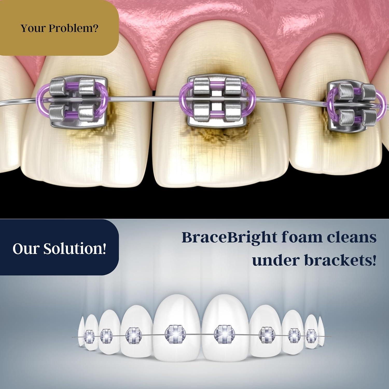 Kit de Blanqueamiento Dental BraceBright para Frenos - Sin Sensibilidad