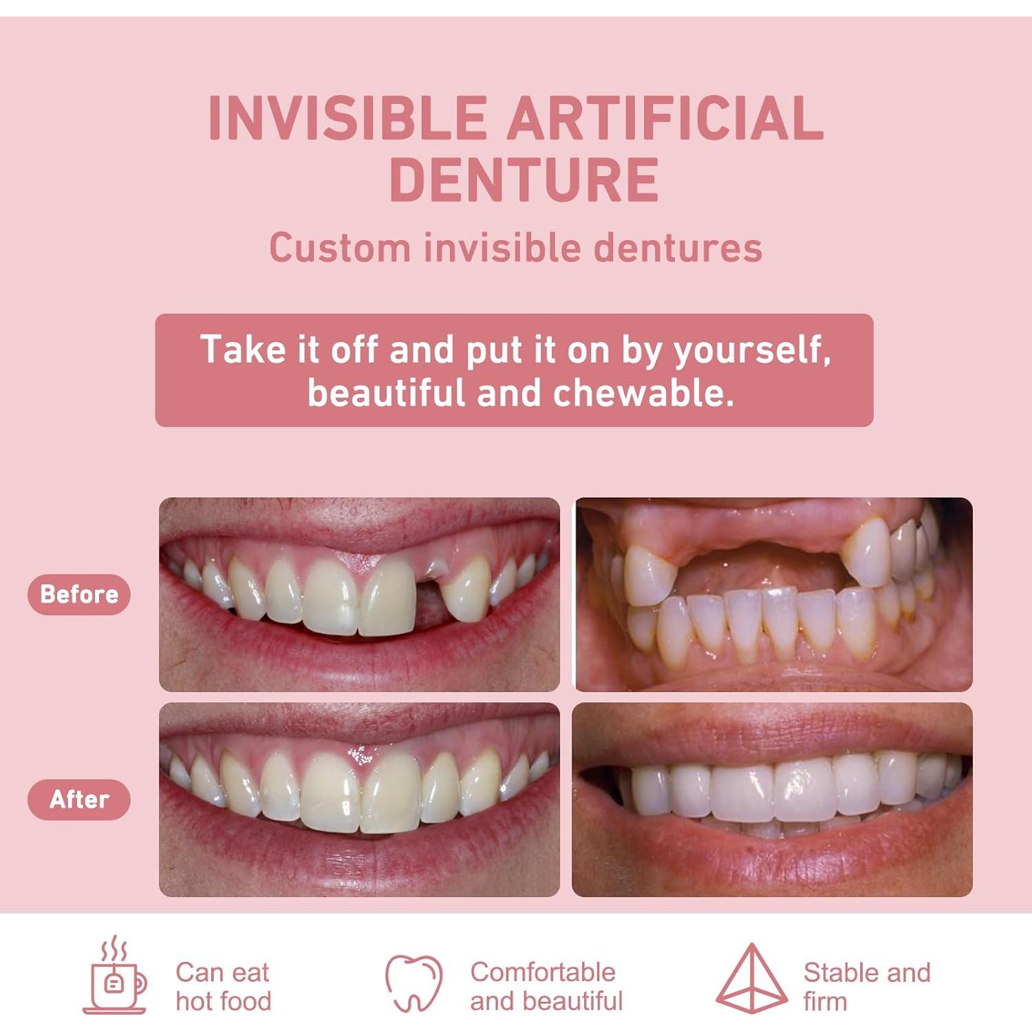 Dentadura Parcial Personalizada Mevivism para 1 Diente - Ajuste Cómodo